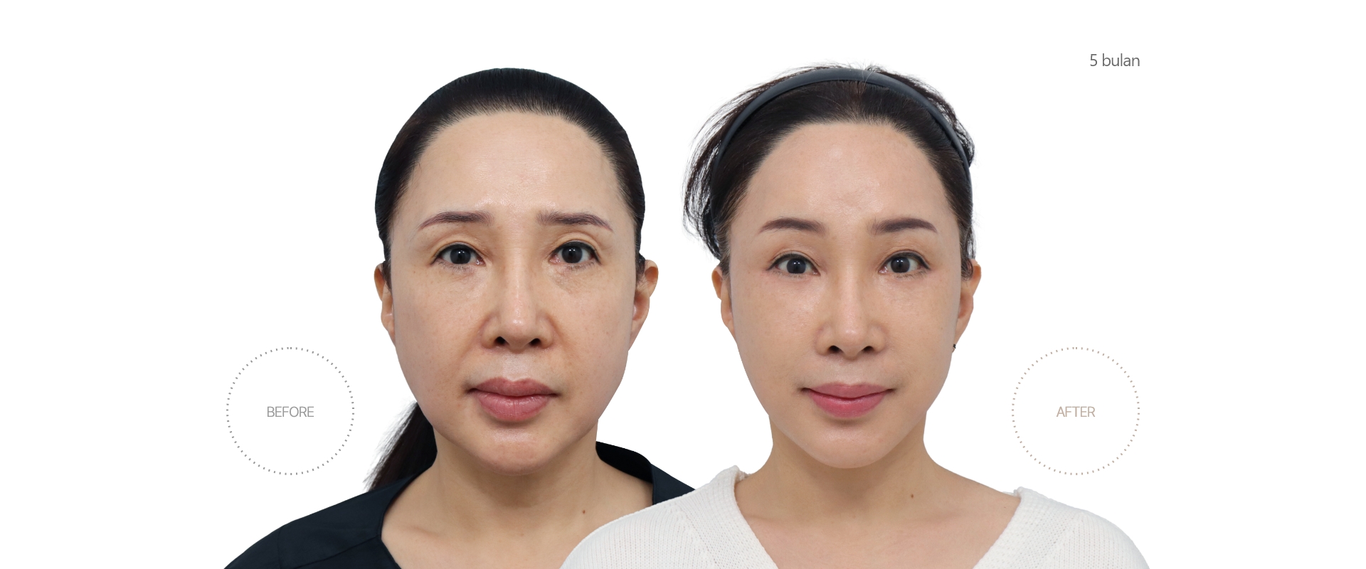 5bulan BEFORE - AFTER