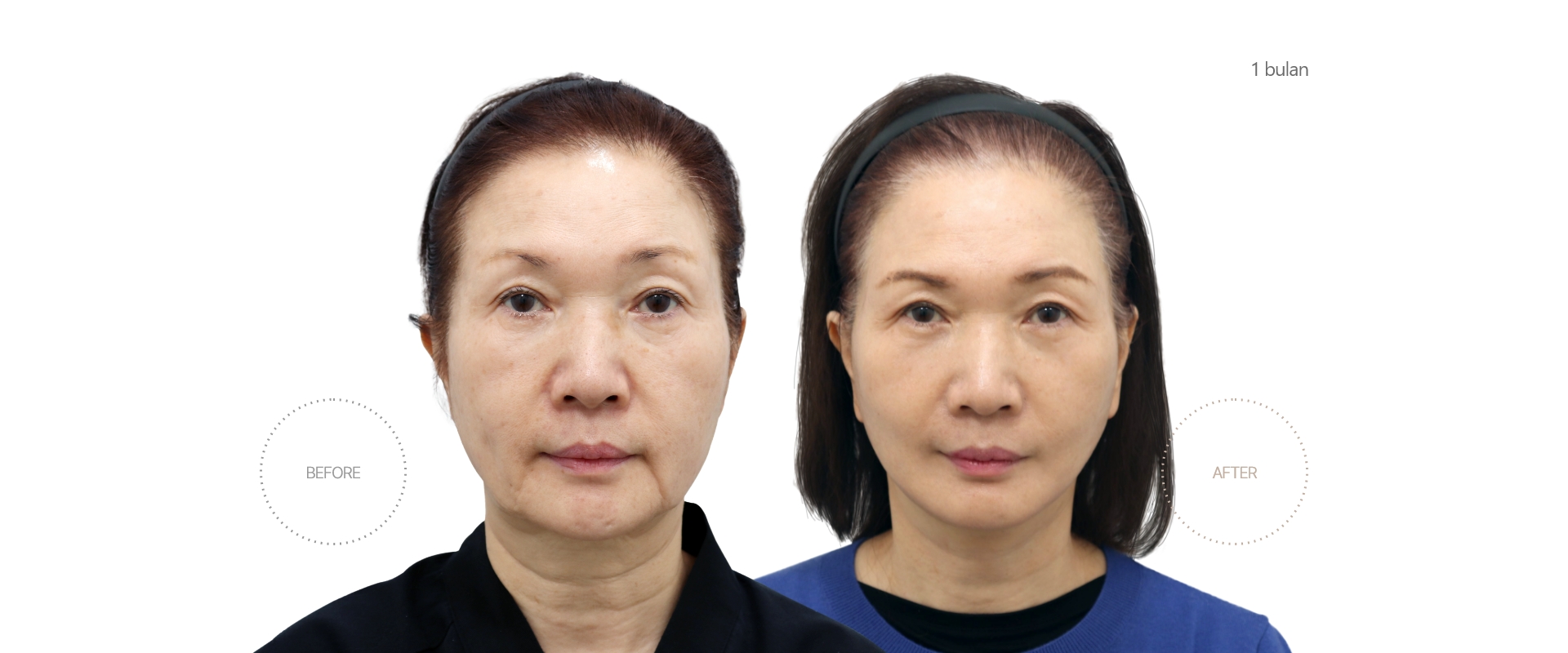 5bulan BEFORE - AFTER