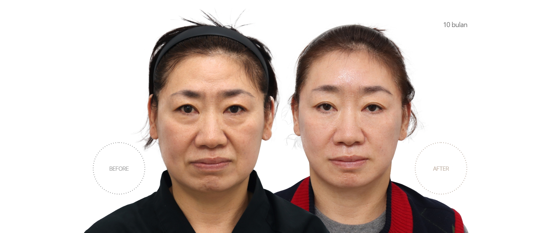 5bulan BEFORE - AFTER