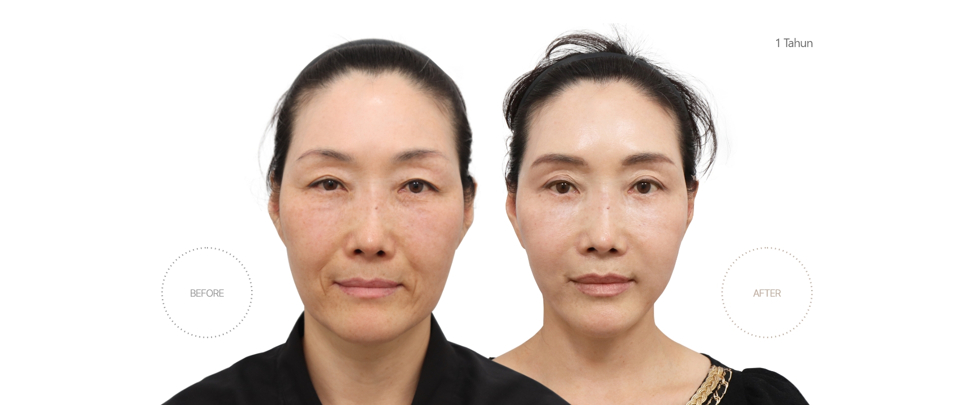 5bulan BEFORE - AFTER