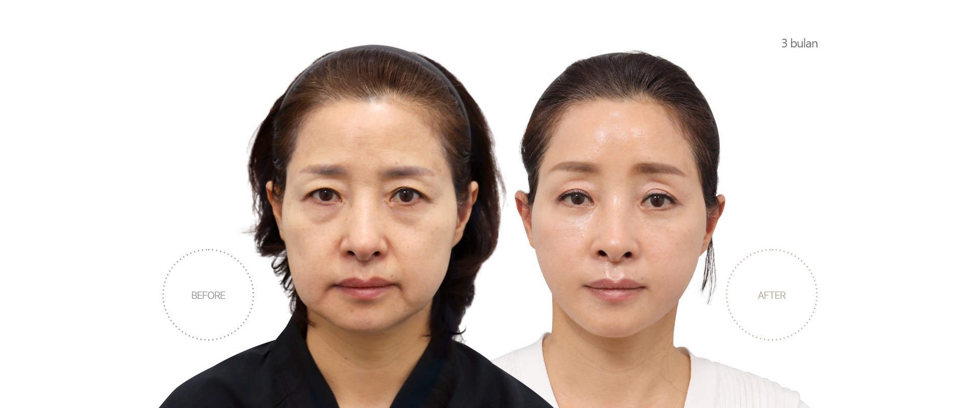 5bulan BEFORE - AFTER