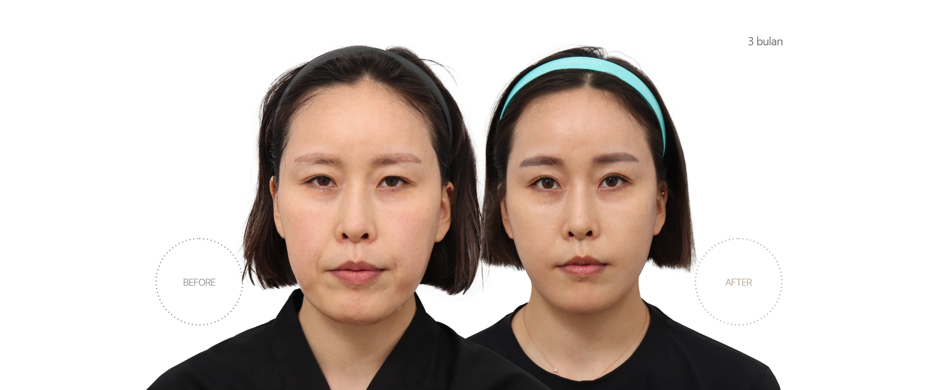 5bulan BEFORE - AFTER