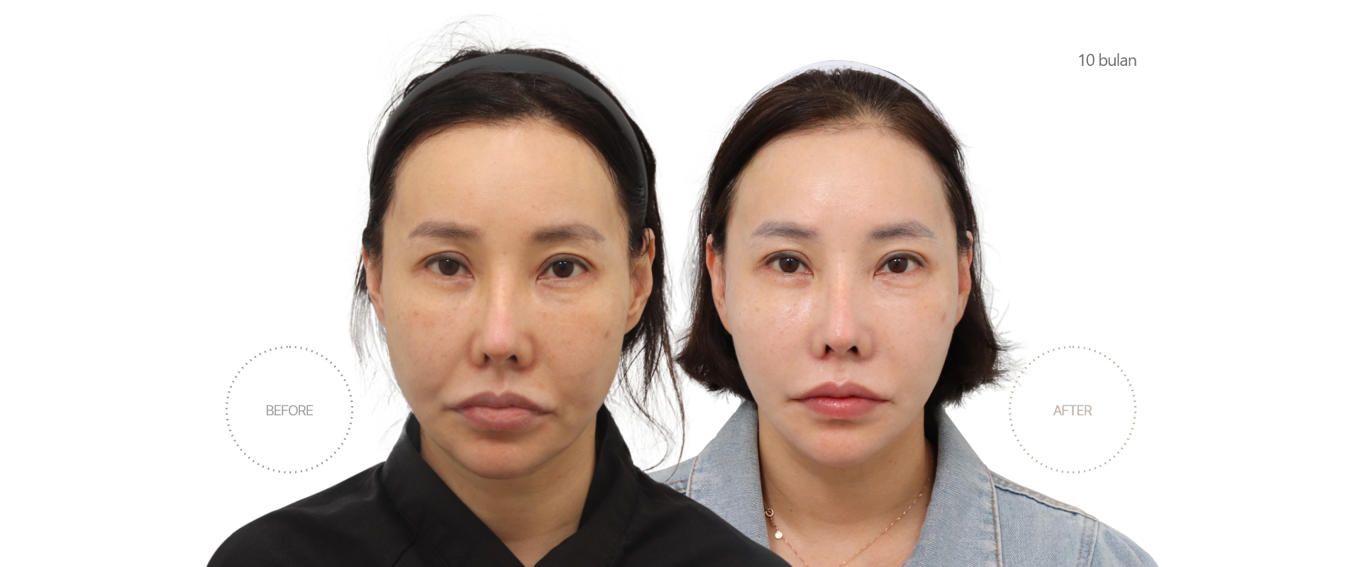 5bulan BEFORE - AFTER