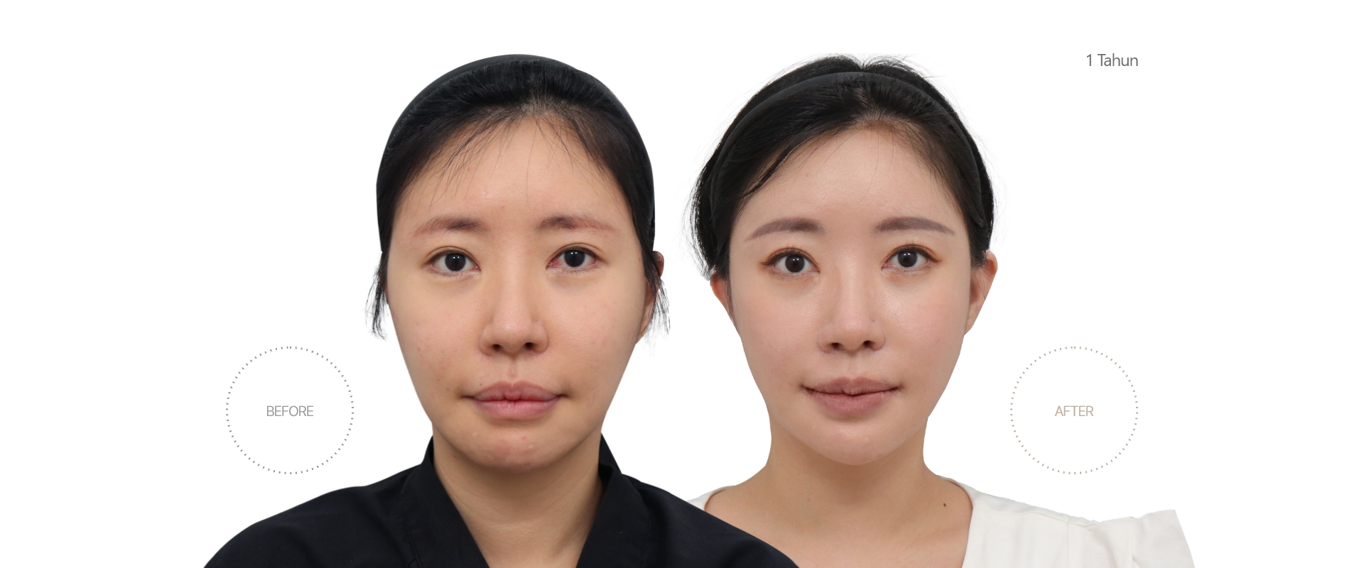 5bulan BEFORE - AFTER