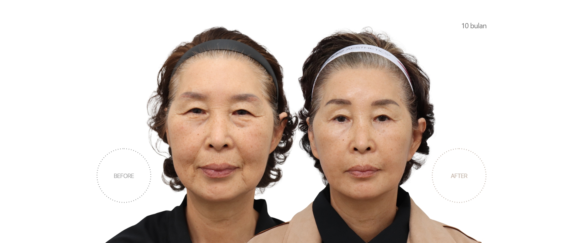 5bulan BEFORE - AFTER