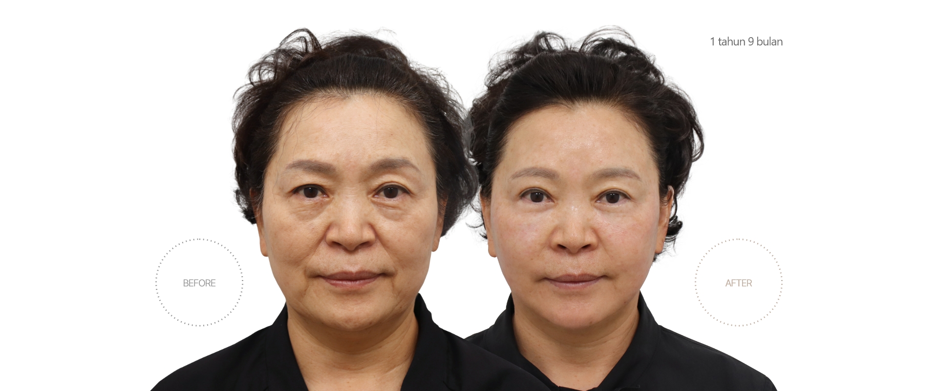 5bulan BEFORE - AFTER