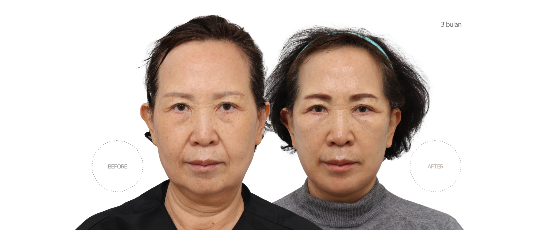 5bulan BEFORE - AFTER