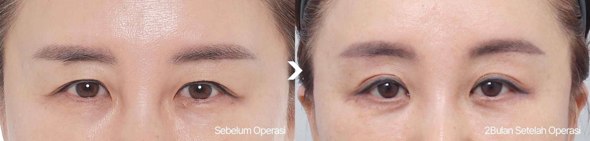 Sebelum Operasi 2Bulan Setelah Operasi