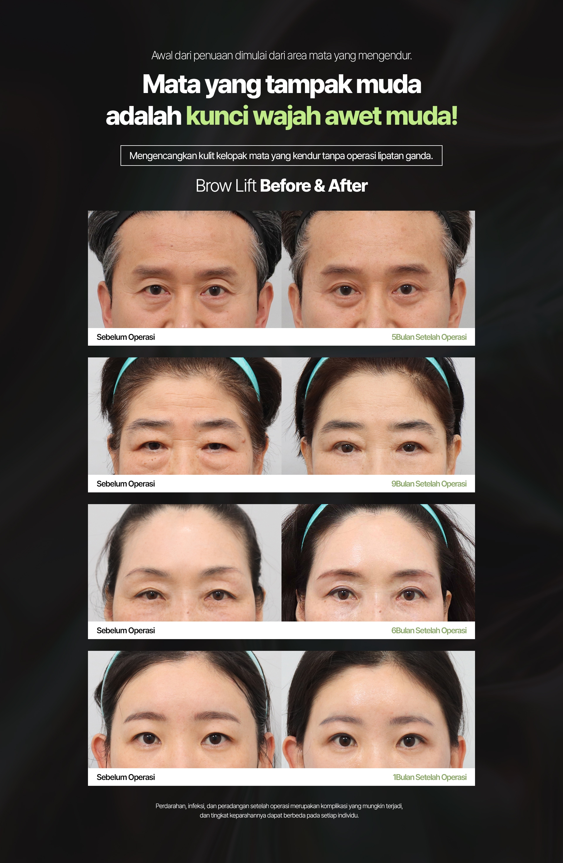 Awal dari penuaan dimulai dari area mata yang mengendur. Mata yang tampak muda adalah kunci wajah awet muda! Mengencangkan kulit kelopak mata yang kendur tanpa operasi lipatan ganda. Brow Lift Before & After Sebelum Operasi 5Bulan Setelah Operasi Perdarahan, infeksi, dan peradangan setelah operasi merupakan komplikasi yang mungkin terjadi, dan tingkat keparahannya dapat berbeda pada setiap individu.