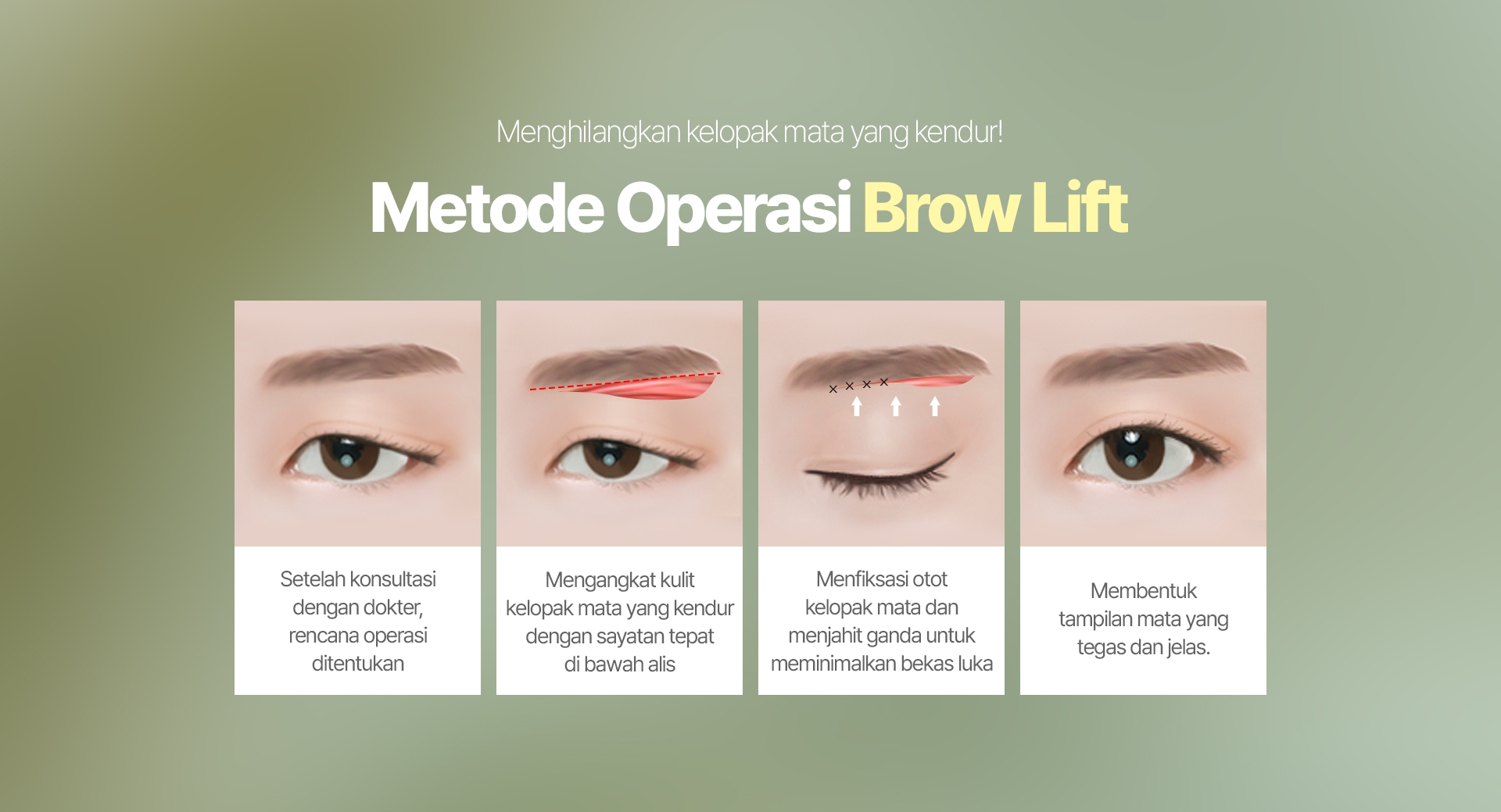 Menghilangkan kelopak mata yang kendur! Metode Operasi Brow Lift Setelah konsultasi dengan dokter, rencana operasi ditentukan Mengangkat kulit kelopak mata yang kendur dengan sayatan tepat di bawah alis Menfiksasi otot kelopak mata dan menjahit ganda untuk meminimalkan bekas luka Membentuk tampilan mata yang tegas dan jelas.