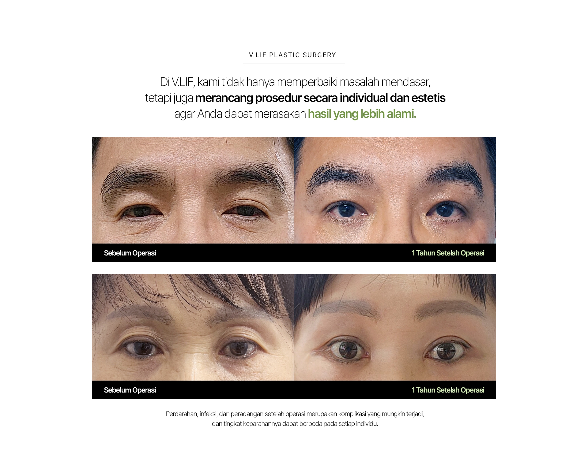 V.LIF PLASTIC SURGERY Di V.LIF, kami tidak hanya memperbaiki masalah mendasar, tetapi juga merancang prosedur secara individual dan estetis agar Anda dapat merasakan hasil yang lebih alami. Sebelum Operasi 1 Tahun Setelah Operasi Perdarahan, infeksi, dan peradangan setelah operasi merupakan komplikasi yang mungkin terjadi, dan tingkat keparahannya dapat berbeda pada setiap individu.