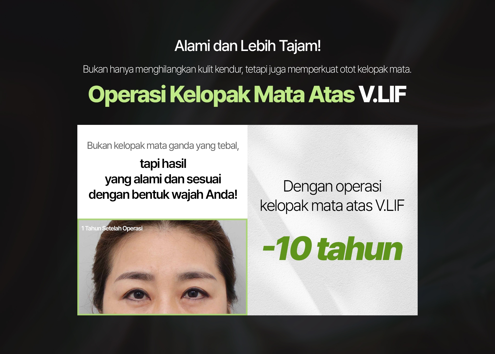 Alami dan Lebih Tajam! Bukan hanya menghilangkan kulit kendur, tetapi juga memperkuat otot kelopak mata. Operasi Kelopak Mata Atas V.LIF Bukan kelopak mata ganda yang tebal, tapi hasil yang alami dan sesuai dengan bentuk wajah Anda! 1 Tahun Setelah Operasi Dengan operasi kelopak mata atas V.LIF -10 tahun