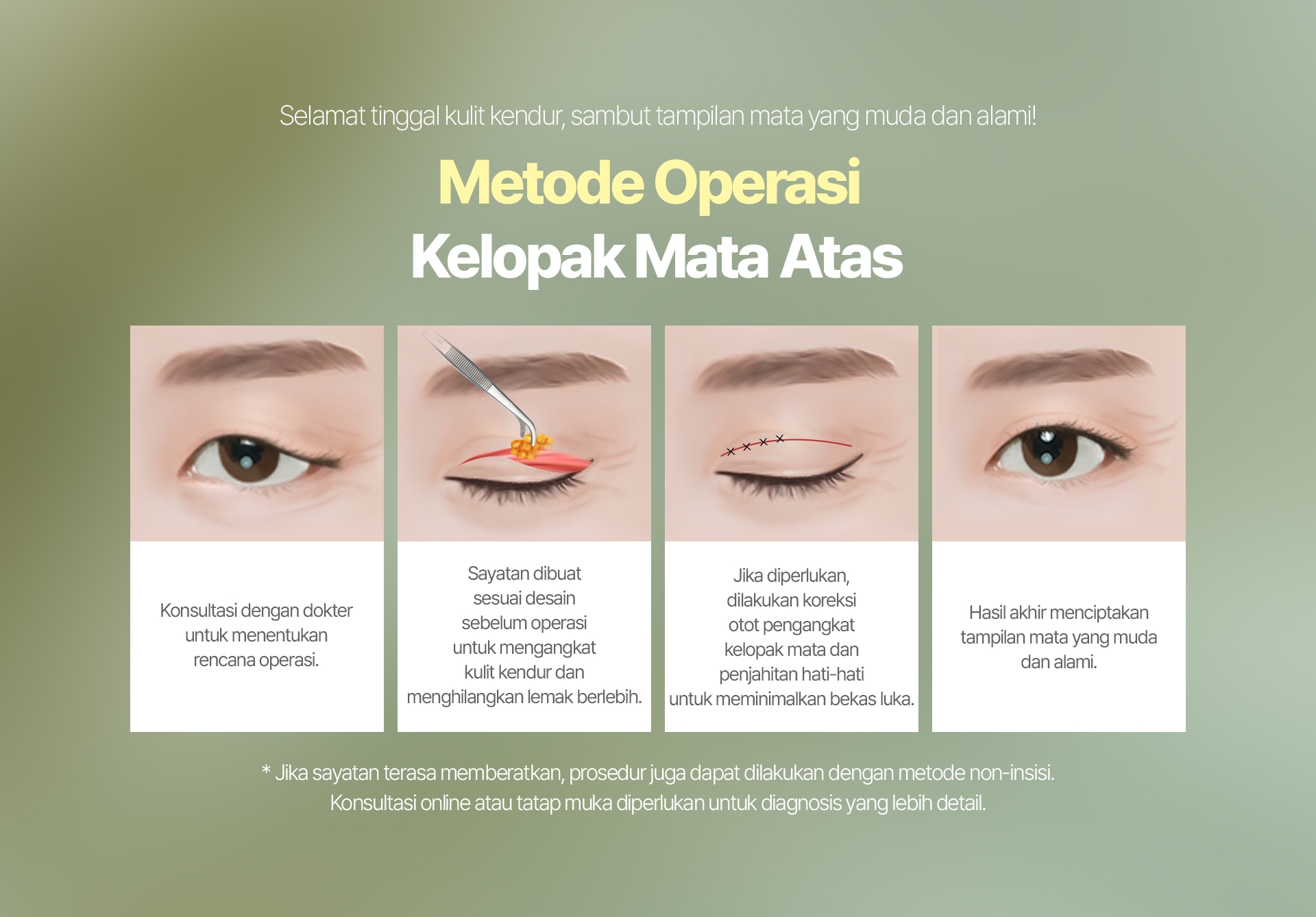 Selamat tinggal kulit kendur, sambut tampilan mata yang muda dan alami! Metode Operasi Kelopak Mata Atas Konsultasi dengan dokter untuk menentukan rencana operasi. Sayatan dibuat sesuai desain sebelum operasi untuk mengangkat kulit kendur dan menghilangkan lemak berlebih. Jika diperlukan, dilakukan koreksi otot pengangkat kelopak mata dan penjahitan hati-hati untuk meminimalkan bekas luka. Hasil akhir menciptakan tampilan mata yang muda dan alami. * Jika sayatan terasa memberatkan, prosedur juga dapat dilakukan dengan metode non-insisi. Konsultasi online atau tatap muka diperlukan untuk diagnosis yang lebih detail.