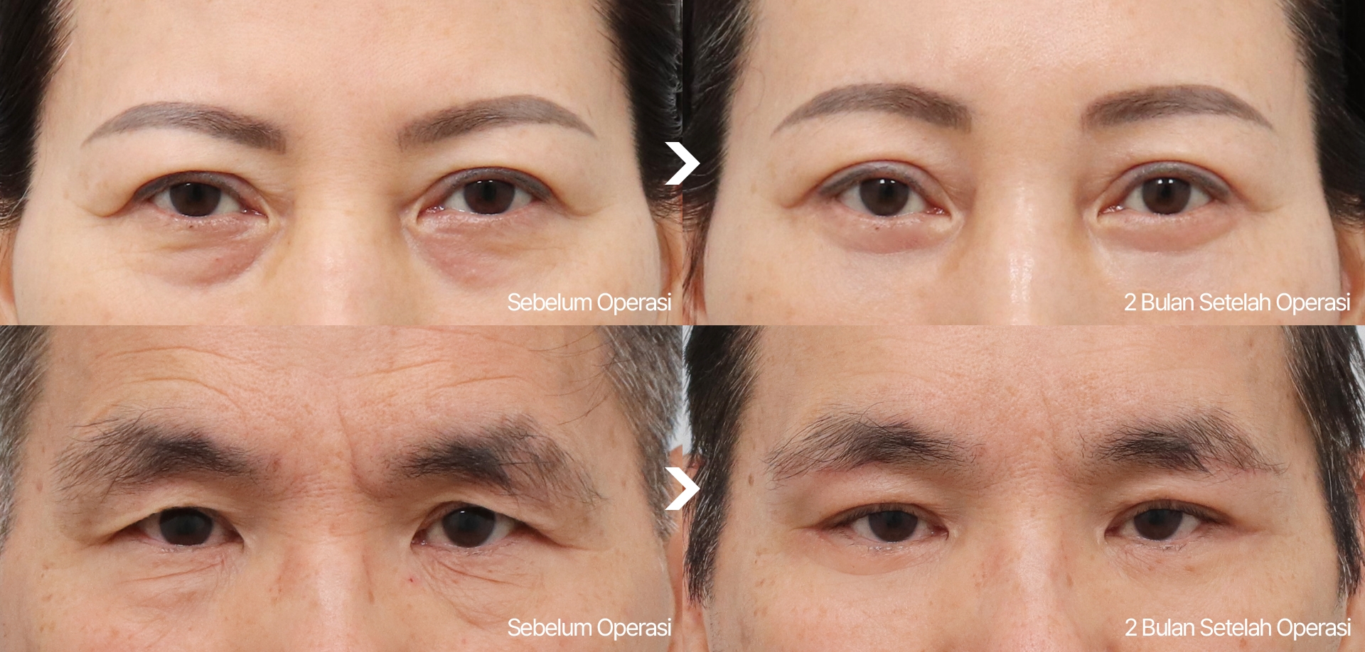 Sebelum Operasi 2 Bulan Setelah Operasi