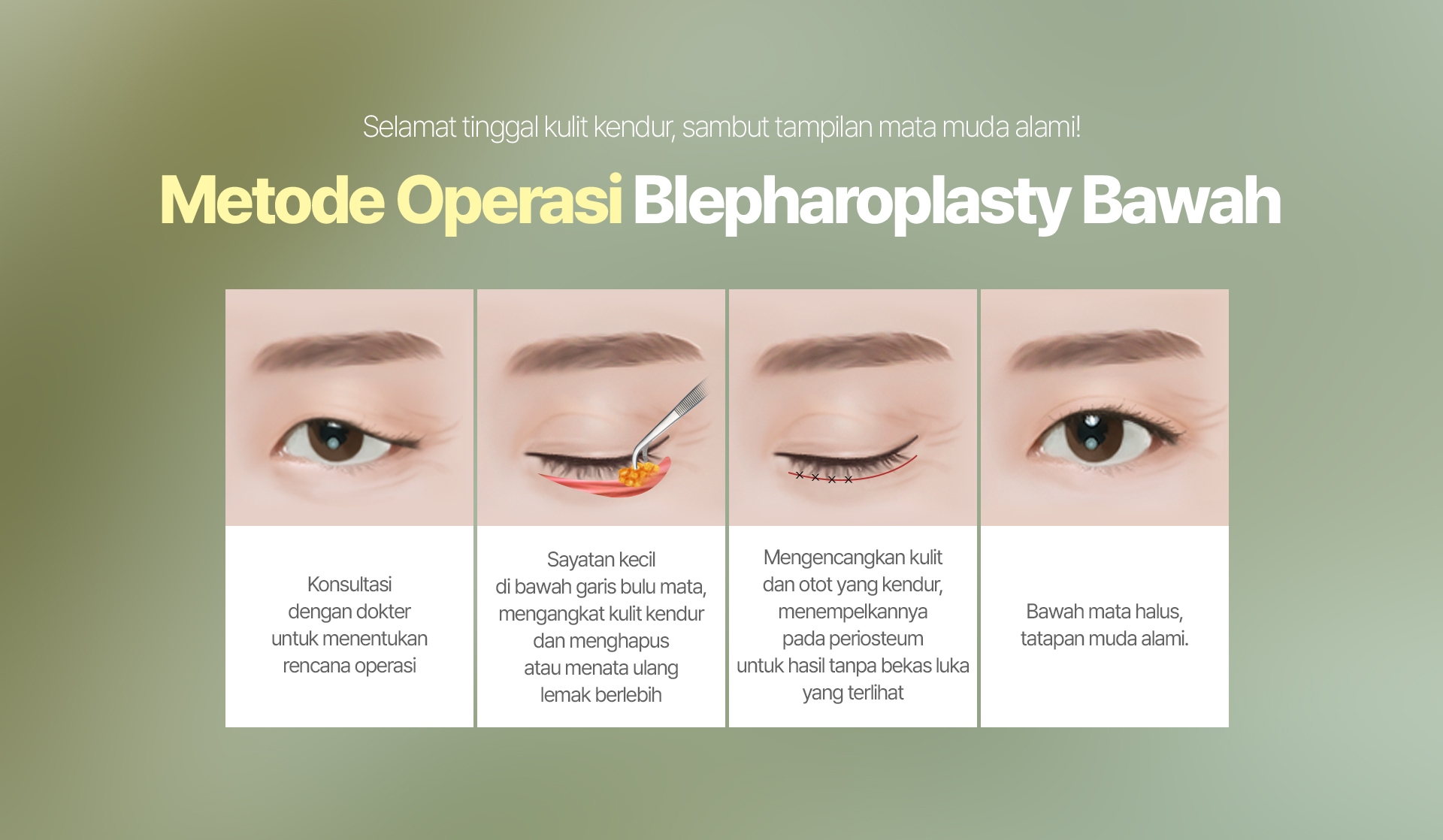 Selamat tinggal kulit kendur, sambut tampilan mata muda alami! Metode Operasi Blepharoplasty Bawah Konsultasi dengan dokter untuk menentukan rencana operasi Sayatan kecil di bawah garis bulu mata, mengangkat kulit kendur dan menghapus atau menata ulang lemak berlebih Mengencangkan kulit dan otot yang kendur, menempelkannya pada periosteum untuk hasil tanpa bekas luka yang terlihat Bawah mata halus, tatapan muda alami.