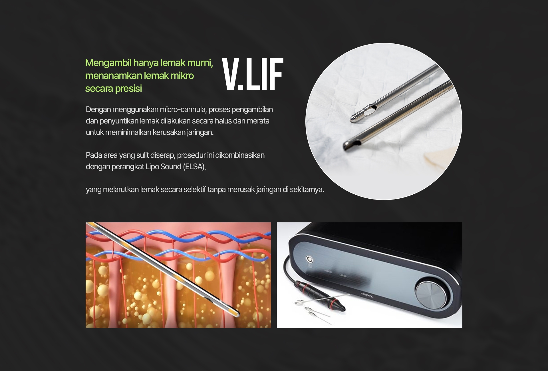 Mengambil hanya lemak murni, menanamkan lemak mikro secara presisi V.LIF Dengan menggunakan micro-cannula, proses pengambilan dan penyuntikan lemak dilakukan secara halus dan merata untuk meminimalkan kerusakan jaringan. Pada area yang sulit diserap, prosedur ini dikombinasikan dengan perangkat Lipo Sound (ELSA), yang melarutkan lemak secara selektif tanpa merusak jaringan di sekitarnya.