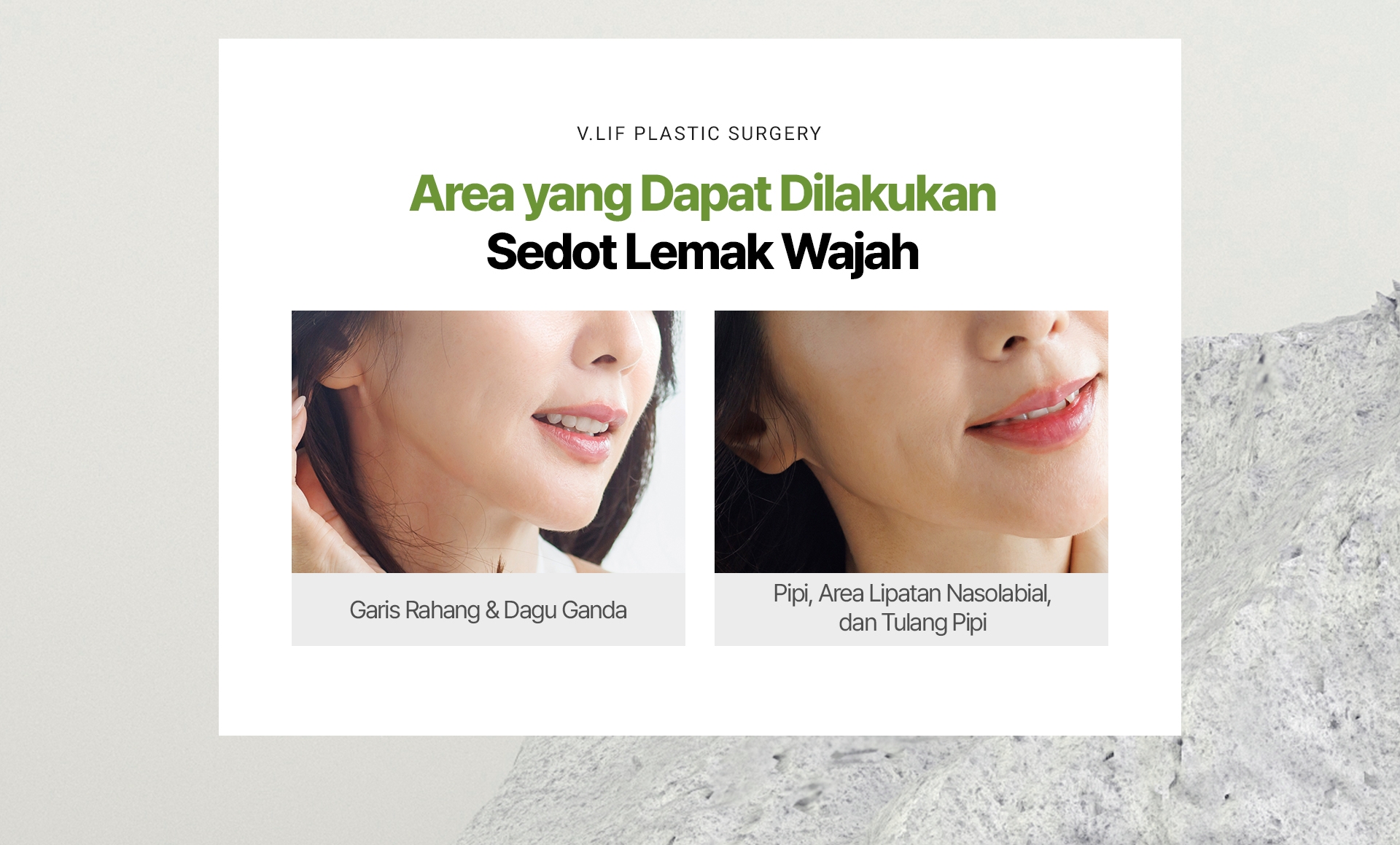 V.LIF PLASTIC SURGERY Area yang Dapat Dilakukan Sedot Lemak Wajah Garis Rahang & Dagu Ganda Pipi, Area Lipatan Nasolabial, dan Tulang Pipi