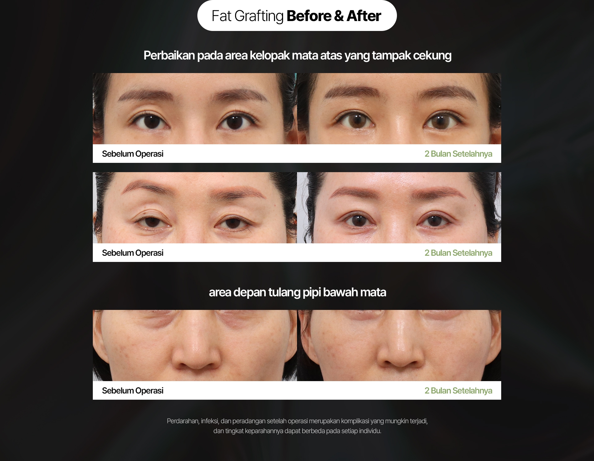 Fat Grafting Before & After Perbaikan pada area kelopak mata atas yang tampak cekung Sebelum Operasi 2 Bulan Setelahnya area depan tulang pipi bawah mata Perdarahan, infeksi, dan peradangan setelah operasi merupakan komplikasi yang mungkin terjadi, dan tingkat keparahannya dapat berbeda pada setiap individu.