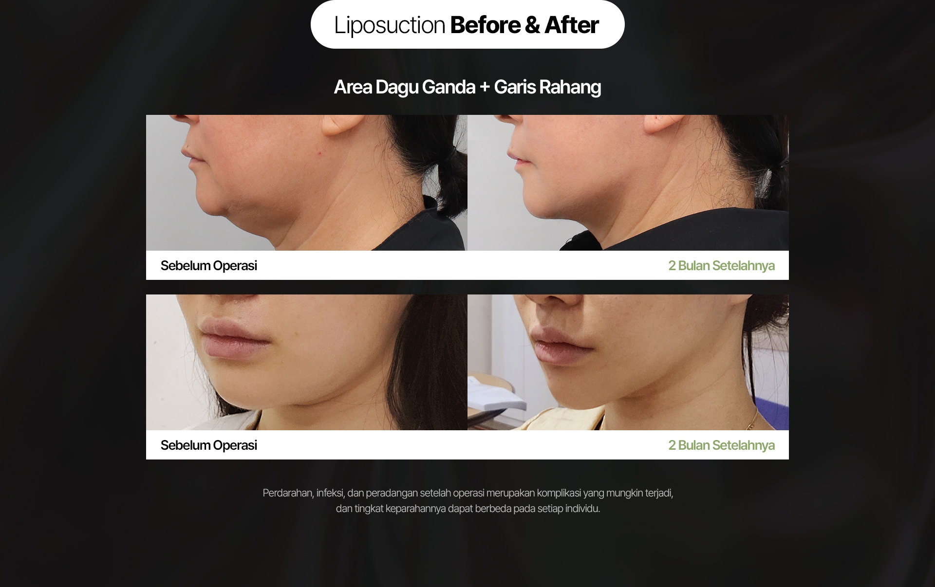 Sebelum Operasi 2 Bulan Setelahnya Perdarahan, infeksi, dan peradangan setelah operasi merupakan komplikasi yang mungkin terjadi, dan tingkat keparahannya dapat berbeda pada setiap individu.
