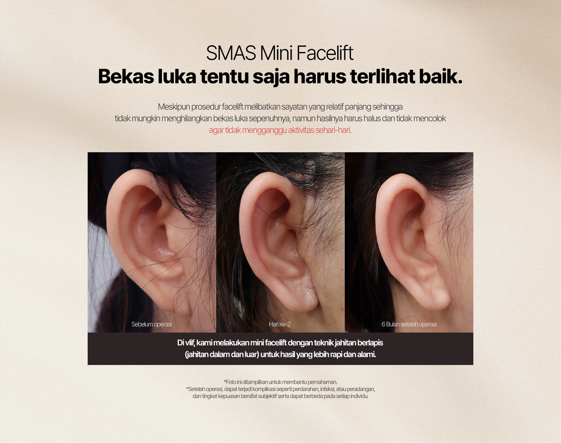 SMAS Mini Facelift Bekas luka tentu saja harus terlihat baik. Meskipun prosedur facelift melibatkan sayatan yang relatif panjang sehingga tidak mungkin menghilangkan bekas luka sepenuhnya, namun hasilnya harus halus dan tidak mencolok agar tidak mengganggu aktivitas sehari-hari. Di vlif, kami melakukan mini facelift dengan teknik jahitan berlapis (jahitan dalam dan luar) untuk hasil yang lebih rapi dan alami.