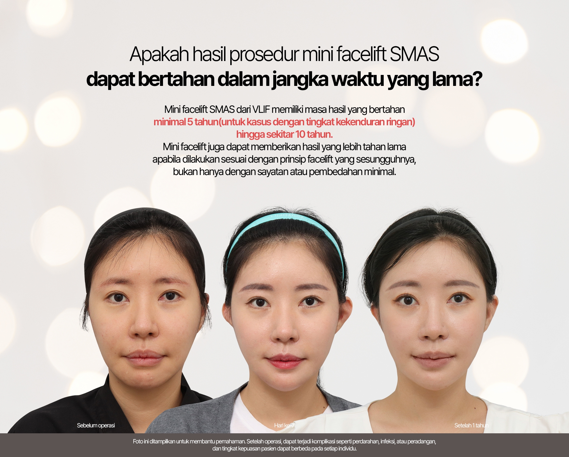 Apakah hasil prosedur mini facelift SMAS dapat bertahan dalam jangka waktu yang lama? Mini facelift SMAS dari VLIF memiliki masa hasil yang bertahan minimal 5 tahun (untuk kasus dengan tingkat kekenduran ringan) hingga sekitar 10 tahun. Mini facelift juga dapat memberikan hasil yang lebih tahan lama apabila dilakukan sesuai dengan prinsip facelift yang sesungguhnya, bukan hanya dengan sayatan atau pembedahan minimal. VLIF mematuhi peraturan medis yang berlaku. Foto perkembangan pasca operasi hanya dapat dilihat setelah login. “Lihat Selengkapnya” Sebelum operasi / Hari ke-7 / Setelah 1 tahun Foto ini ditampilkan untuk membantu pemahaman. Setelah operasi, dapat terjadi komplikasi seperti perdarahan, infeksi, atau peradangan, dan tingkat kepuasan pasien dapat berbeda pada setiap individu