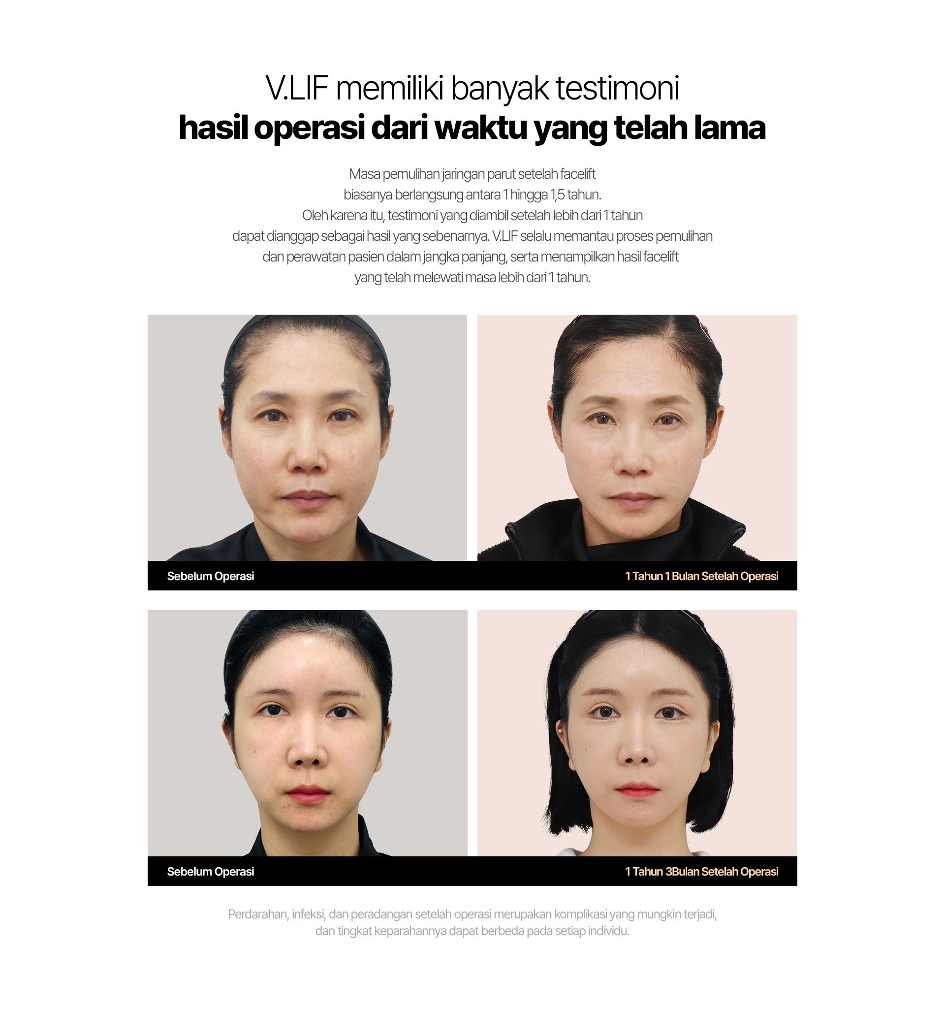 V.LIF memiliki banyak testimoni hasil operasi dari waktu yang telah lama Masa pemulihan jaringan parut setelah facelift biasanya berlangsung antara 1 hingga 1,5 tahun. Oleh karena itu, testimoni yang diambil setelah lebih dari 1 tahun dapat dianggap sebagai hasil yang sebenarnya. V.LIF selalu memantau proses pemulihan dan perawatan pasien dalam jangka panjang, serta menampilkan hasil facelift yang telah melewati masa lebih dari 1 tahun. Sebelum Operasi 1 Tahun 1 Bulan Setelah Operasi Sebelum Operasi Perdarahan, infeksi, dan peradangan setelah operasi merupakan komplikasi yang mungkin terjadi, dan tingkat keparahannya dapat berbeda pada setiap individu. 1 Tahun 3Bulan Setelah Operasi