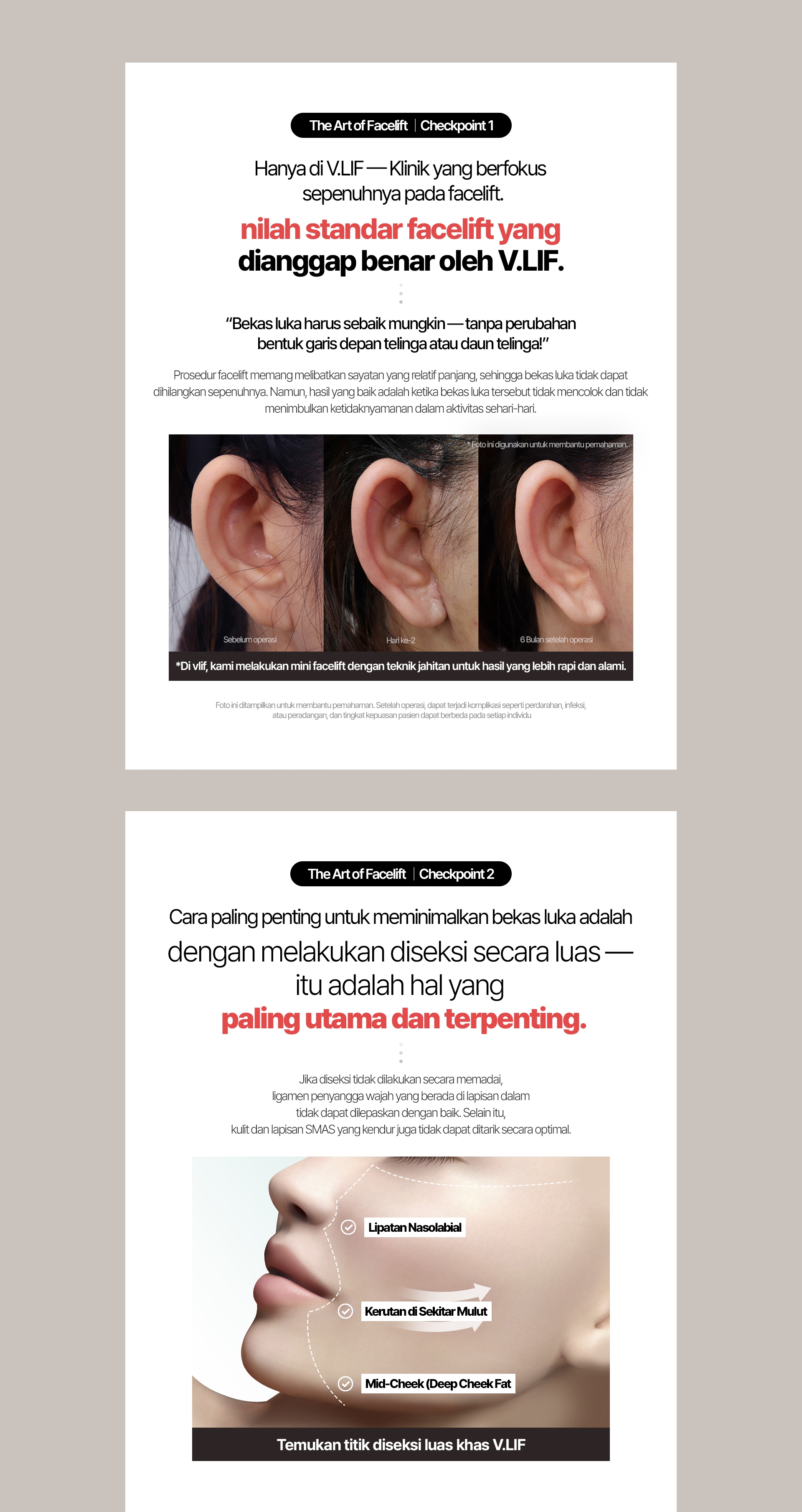 The Art of Facelift / Checkpoint 1 Hanya di VLIF — Klinik yang berfokus sepenuhnya pada facelift. nilah standar facelift yang  dianggap benar oleh VLIF. “Bekas luka harus sebaik mungkin — tanpa perubahan bentuk garis depan telinga atau daun telinga!” Prosedur facelift memang melibatkan sayatan yang relatif panjang, sehingga bekas luka tidak dapat dihilangkan sepenuhnya. Namun, hasil yang baik adalah ketika bekas luka tersebut tidak mencolok dan tidak menimbulkan ketidaknyamanan dalam aktivitas sehari-hari. Sebelum operasi / Hari ke-2 / 6 Bulan setelah operasi Di vlif, kami melakukan mini facelift dengan teknik jahitan untuk hasil yang lebih rapi dan alami. Foto ini ditampilkan untuk membantu pemahaman. Setelah operasi, dapat terjadi komplikasi seperti perdarahan, infeksi, atau peradangan, dan tingkat kepuasan pasien dapat berbeda pada setiap individu The Art of Facelift / Checkpoint 2 Cara paling penting untuk meminimalkan bekas luka adalah dengan melakukan diseksi secara luas — itu adalah hal yang paling utama dan terpenting. Jika diseksi tidak dilakukan secara memadai, ligamen penyangga wajah yang berada di lapisan dalam tidak dapat dilepaskan  dengan baik. Selain itu, kulit dan lapisan SMAS yang kendur juga tidak dapat ditarik secara optimal. Temukan titik diseksi luas khas V.LIF Lipatan Nasolabial Kerutan di Sekitar Mulut Mid-Cheek