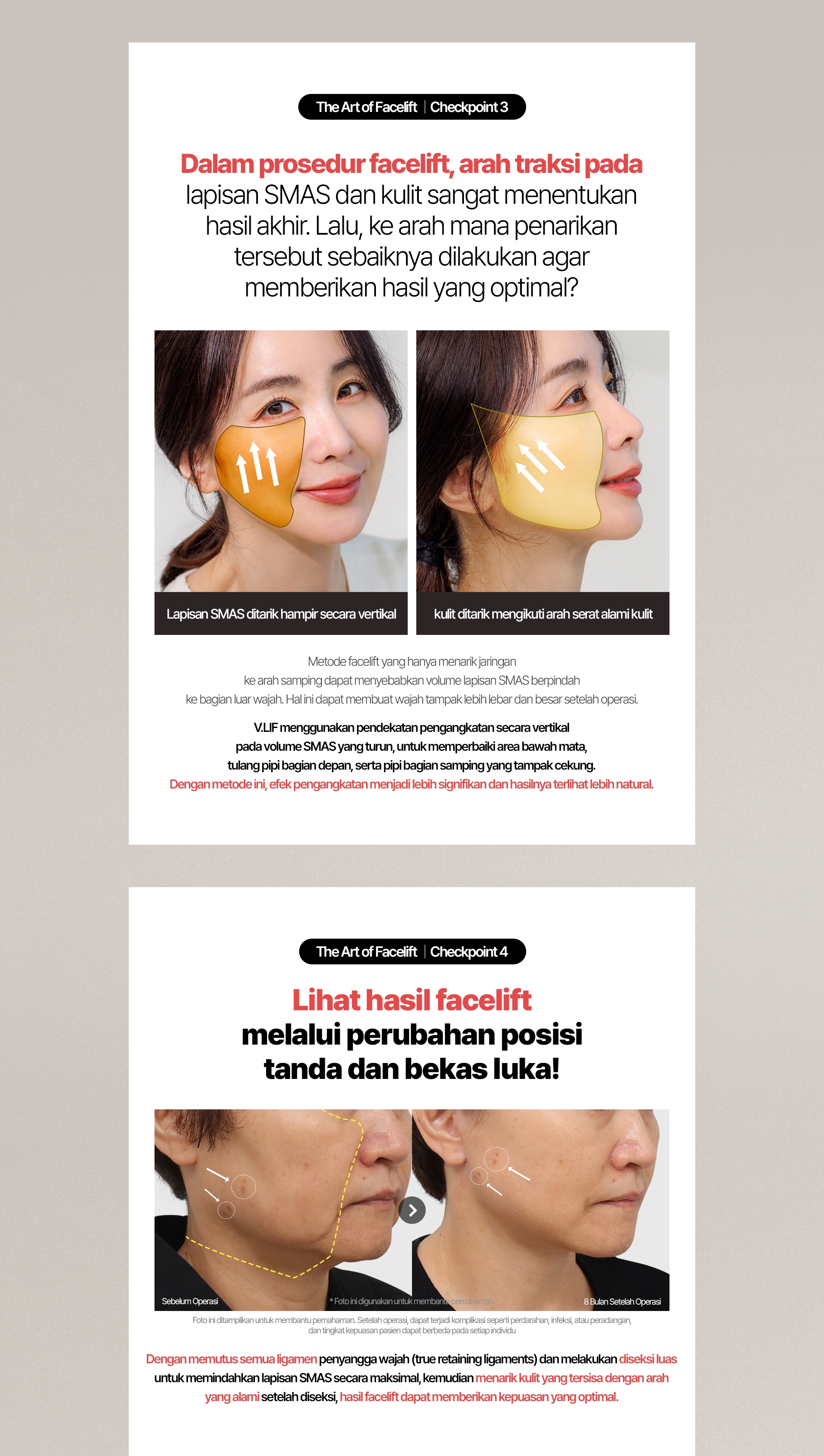 The Art of Facelift / Checkpoint 3 Dalam prosedur facelift, arah traksi pada lapisan SMAS dan kulit sangat menentukan hasil akhir. Lalu, ke arah mana penarikan tersebut sebaiknya dilakukan agar memberikan hasil yang optimal? Lapisan SMAS ditarik hampir secara vertikal kulit ditarik mengikuti arah serat alami kulit Metode facelift yang hanya menarik jaringan ke arah samping dapat menyebabkan volume lapisan SMAS berpindah ke bagian luar wajah. Hal ini dapat membuat wajah tampak lebih lebar dan besar setelah operasi. V.LIF menggunakan pendekatan pengangkatan secara vertikal pada volume SMAS yang turun, untuk memperbaiki area bawah mata, tulang pipi bagian depan, serta pipi bagian samping yang tampak cekung. Dengan metode ini, efek pengangkatan menjadi lebih signifikan dan hasilnya terlihat lebih natural. The Art of Facelift / Checkpoint 4 Lihat hasil facelift melalui perubahan posisi tanda dan bekas luka! Sebelum Operasi / 8 Bulan Setelah Operasi * Foto ini digunakan untuk membantu pemahaman. Foto ini ditampilkan untuk membantu pemahaman. Setelah operasi, dapat terjadi komplikasi seperti perdarahan, infeksi, atau peradangan, dan tingkat kepuasan pasien dapat berbeda pada setiap individu Dengan memutus semua ligamen penyangga wajah dan melakukan diseksi luas untuk memindahkan lapisan SMAS secara maksimal, kemudian menarik kulit  yang tersisa dengan arah yang alami setelah diseksi, hasil facelift dapat memberikan kepuasan yang optimal.
