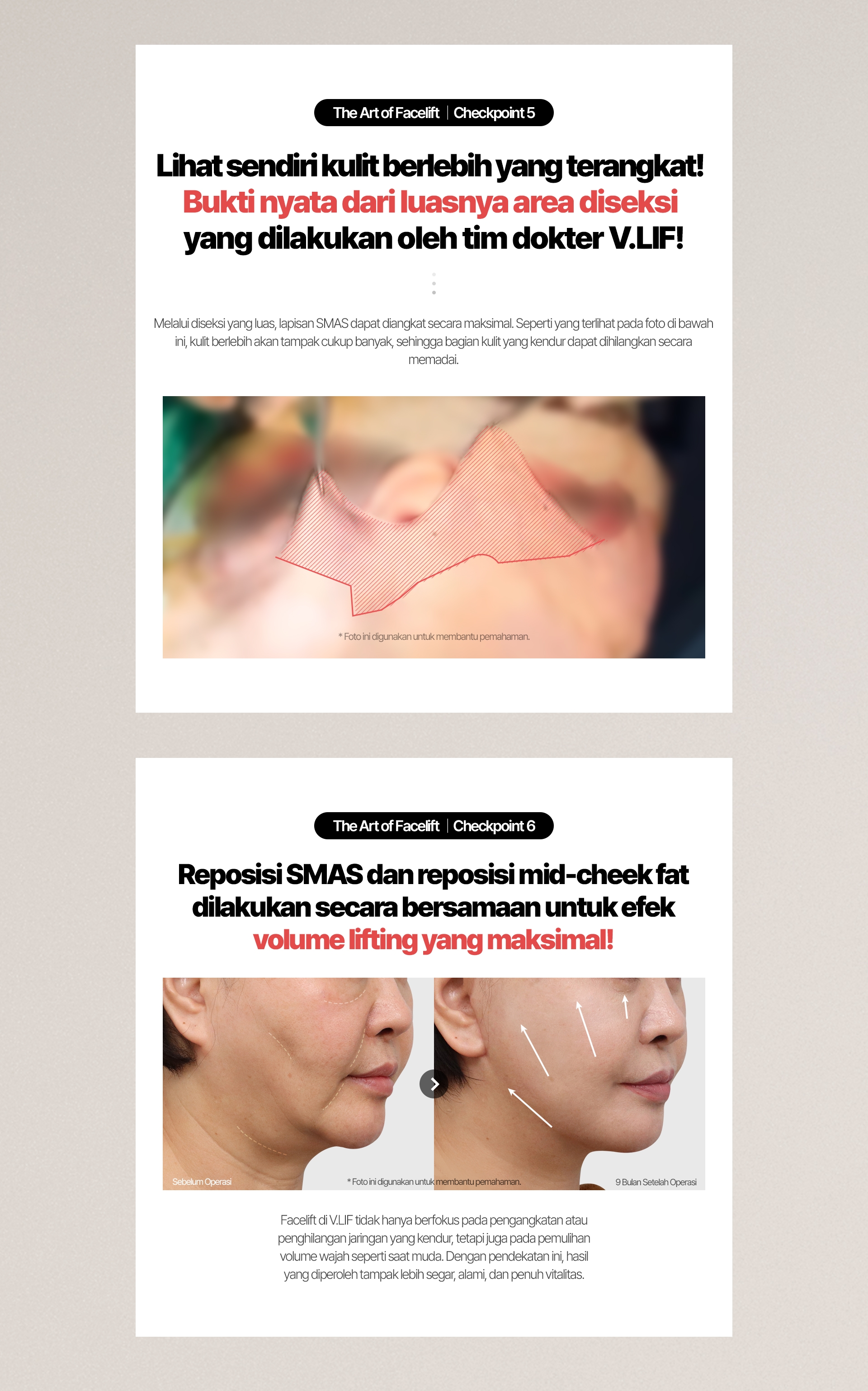 The Art of Facelift / Checkpoint 5 Lihat sendiri kulit berlebih yang terangkat! Bukti nyata dari luasnya area diseksi yang dilakukan oleh tim dokter V.LIF! Melalui diseksi yang luas, lapisan SMAS dapat diangkat secara maksimal. Seperti yang terlihat pada foto di bawah ini, kulit berlebih akan tampak cukup banyak, sehingga bagian kulit yang kendur dapat dihilangkan secara memadai. * Foto ini digunakan untuk membantu pemahaman. The Art of Facelift / Checkpoint 6 Reposisi SMAS dan reposisi mid-cheek fat dilakukan secara bersamaan untuk efek volume lifting yang maksimal! Sebelum Operasi / 9 Bulan Setelah Operasi Facelift di V.LIF tidak hanya berfokus pada pengangkatan atau penghilangan jaringan yang kendur, tetapi juga pada pemulihan volume wajah seperti saat muda. Dengan pendekatan ini, hasil yang diperoleh tampak lebih segar, alami, dan penuh vitalitas.