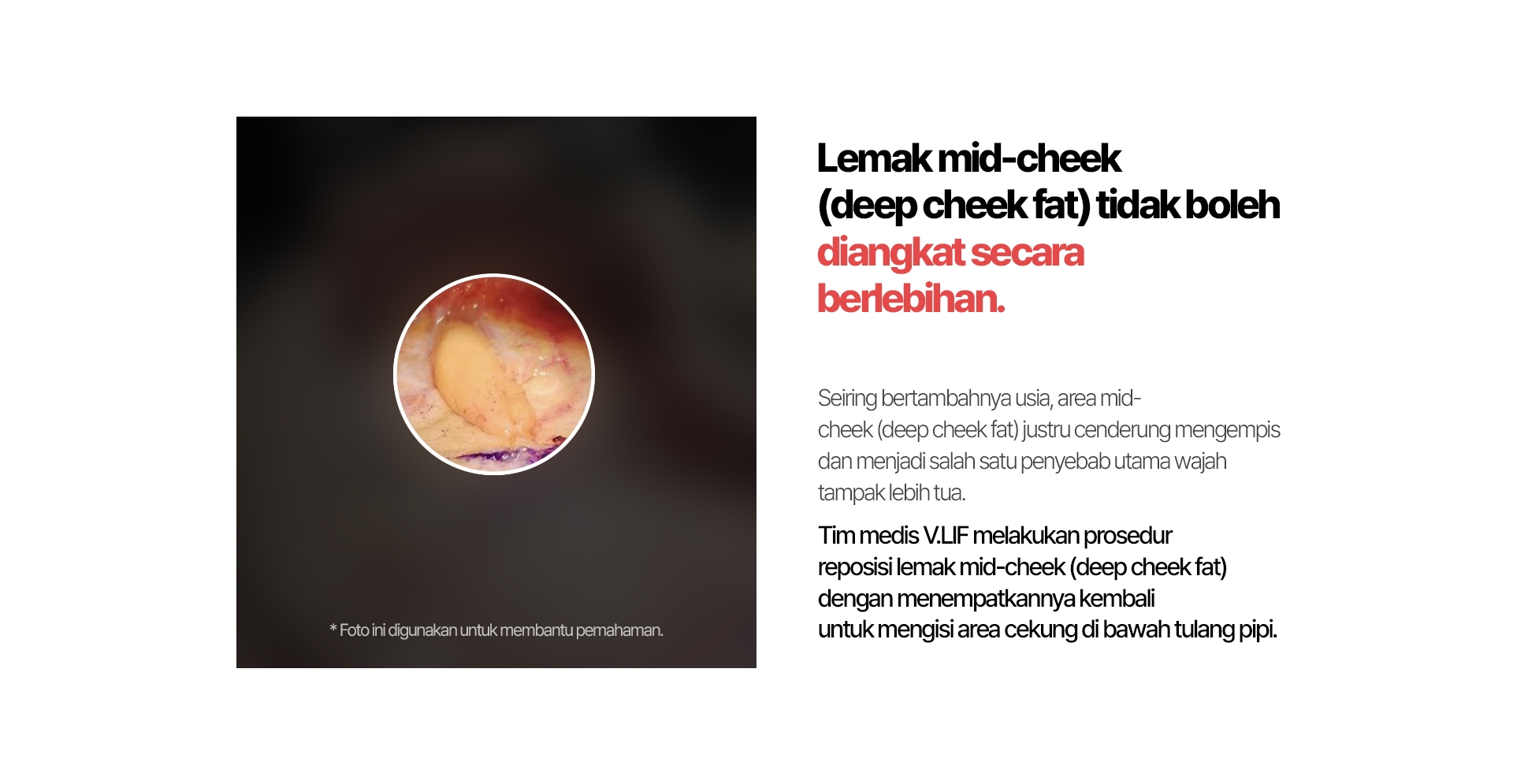 Lemak mid-cheek boleh diangkat secara berlebihan. Seiring bertambahnya usia, area mid-cheek justru cenderung mengempis dan menjadi salah satu penyebab utama wajah tampak lebih tua. Tim medis V.LIF melakukan prosedur reposisi lemak mid-cheek dengan menempatkannya kembali untuk mengisi area cekung di bawah tulang pipi.