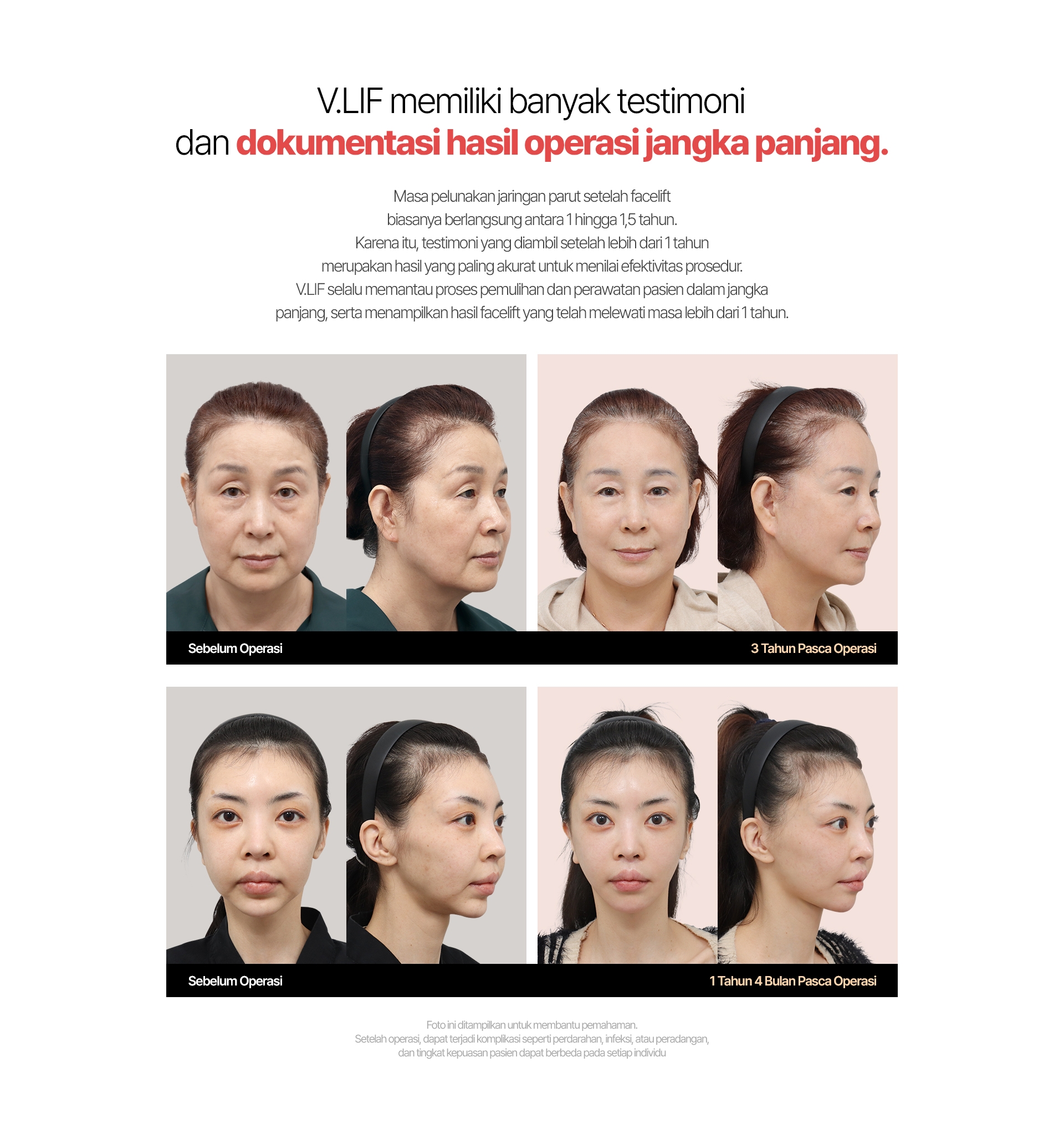 Facelift V.LIF Dibuktikan oleh Waktu. Kepuasan Tinggi, Hasil yang Tahan Lama Fakta, bukan sekadar rumor — hasil facelift V.LIF memang terbukti bertahan lebih lama! Dengan garis sayatan yang bersih serta teknik diseksi luas yang meminimalkan kerusakan jaringan dan saraf, hasil operasi dapat bertahan lebih lama secara alami. Sebelum Operasi | 1 Tahun Pasca Operasi | 3 Tahun Pasca Operasi Foto ini ditampilkan untuk membantu pemahaman. Setelah operasi, dapat terjadi komplikasi seperti perdarahan, infeksi, atau peradangan, dan tingkat kepuasan pasien dapat berbeda pada setiap individu