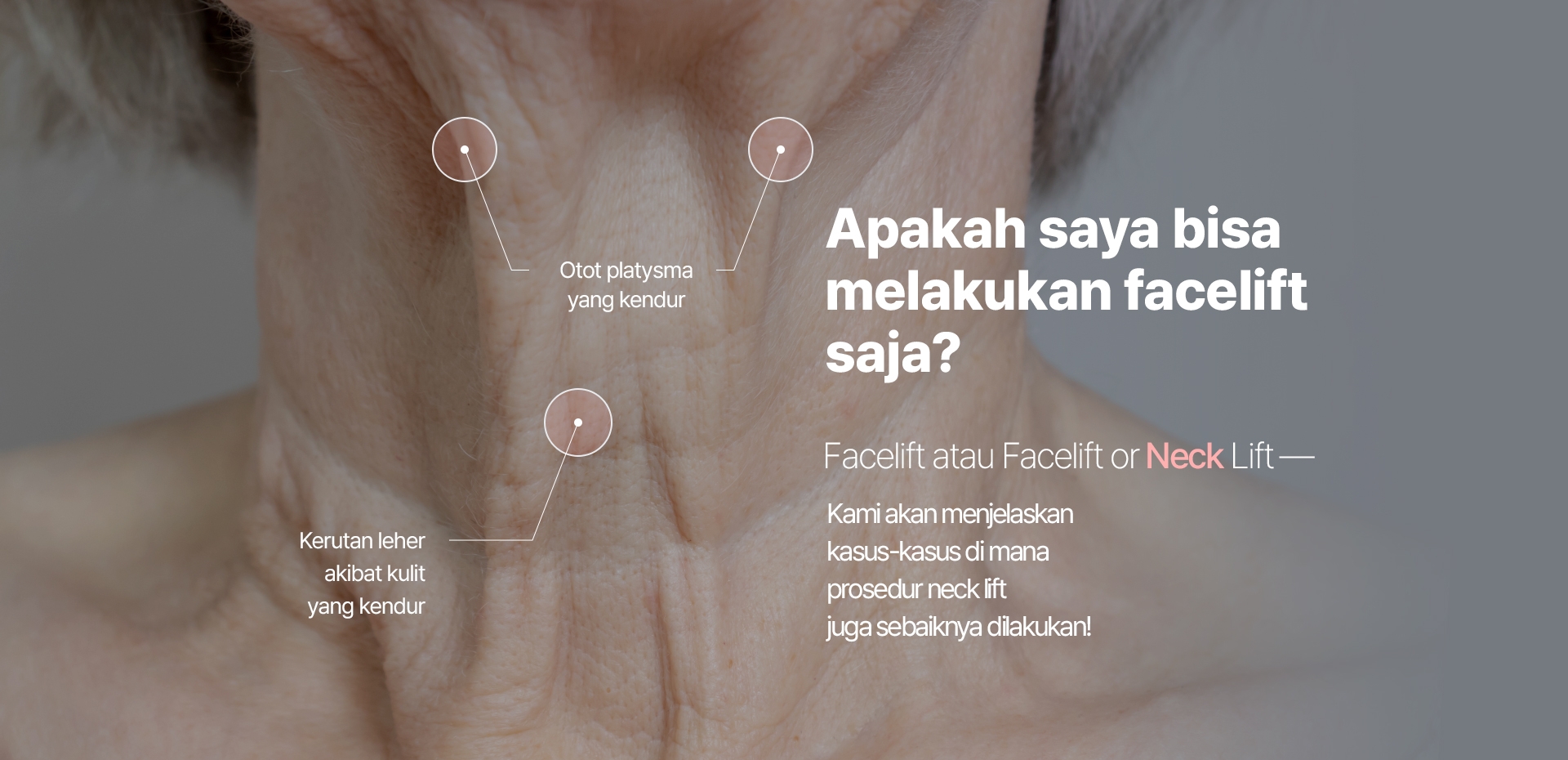 Apakah saya bisa melakukan facelift saja? Facelift atau Facelift or Neck Lift — Kami akan menjelaskan kasus-kasus di mana prosedur neck lift juga sebaiknya dilakukan! Otot platysma yang kendur Kerutan leher akibat kulit yang kendur