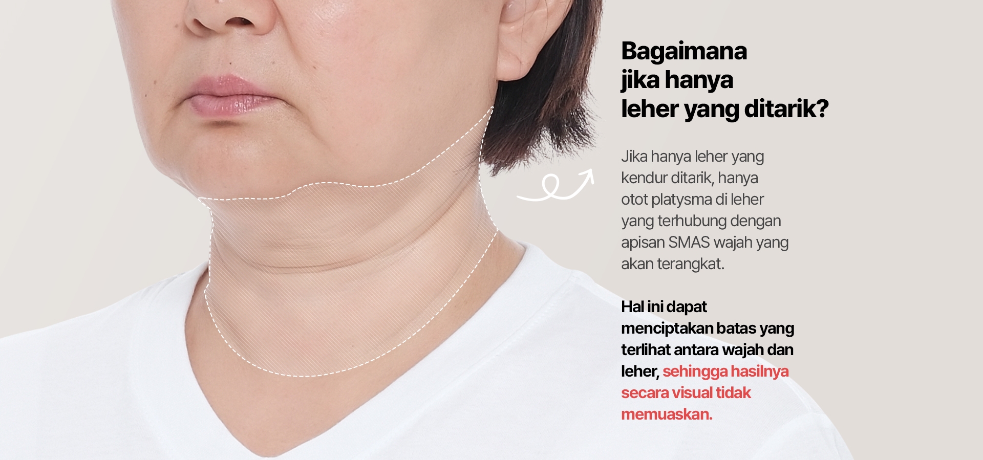 Bagaimana jika hanya leher yang ditarik? Jika hanya leher yang kendur ditarik, hanya otot platysma di leher yang terhubung dengan lapisan SMAS wajah yang akan terangkat. Hal ini dapat menciptakan batas yang terlihat antara wajah dan leher, sehingga hasilnya secara visual tidak memuaskan.
