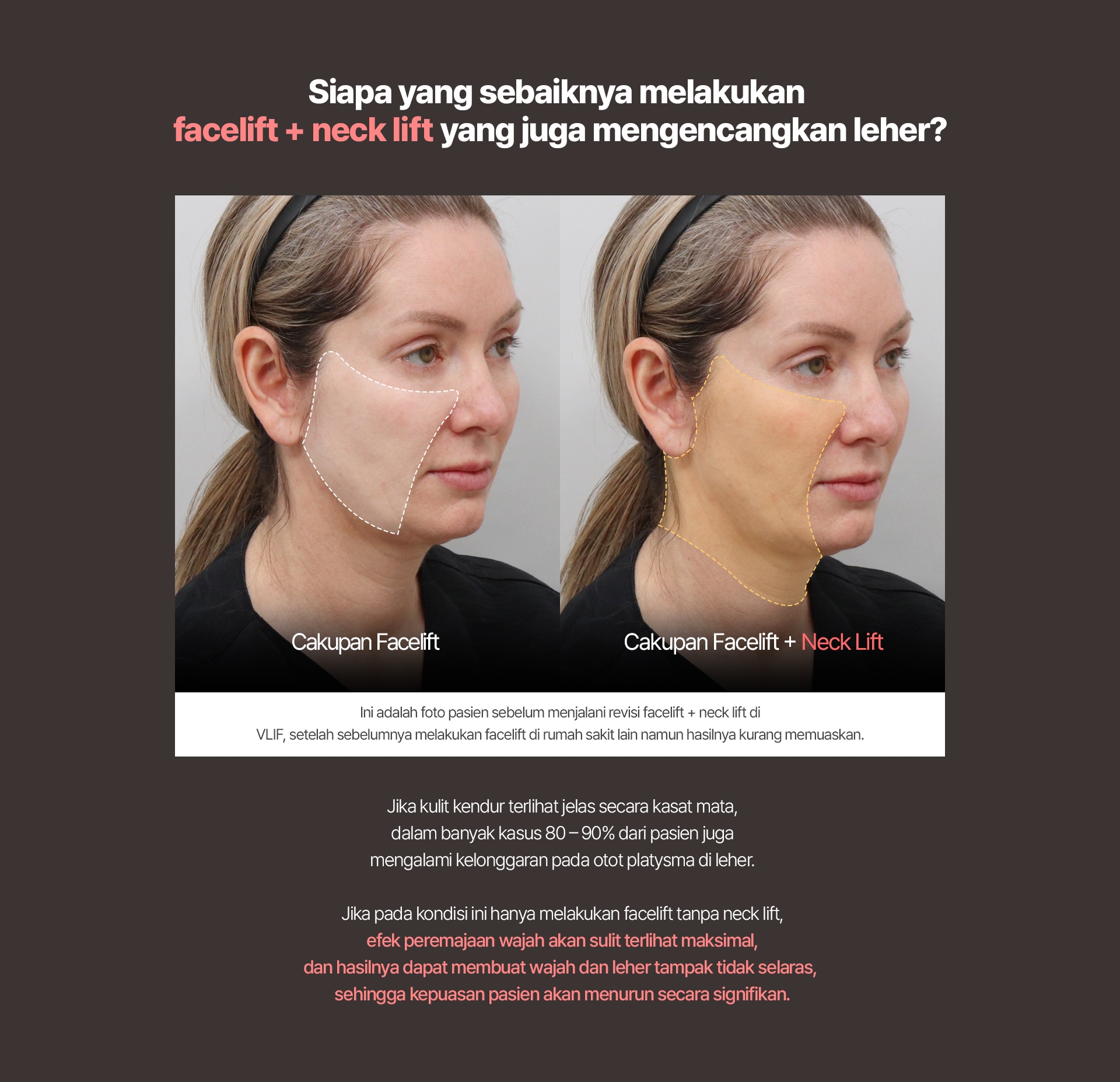 Siapa yang sebaiknya melakukan facelift + neck lift yang juga mengencangkan leher? Cakupan Facelift / Cakupan Facelift + Neck Lift Ini adalah foto pasien sebelum menjalani revisi facelift + neck lift di VLIF, setelah sebelumnya melakukan facelift di rumah sakit lain namun hasilnya kurang memuaskan. Jika kulit kendur terlihat jelas secara kasat mata, dalam banyak kasus 80–90% dari pasien juga mengalami kelonggaran pada otot platysma di leher. Jika pada kondisi ini hanya melakukan facelift tanpa neck lift, efek peremajaan wajah akan sulit terlihat maksimal, dan hasilnya dapat membuat wajah dan leher tampak tidak selaras, sehingga kepuasan pasien akan menurun secara signifikan.