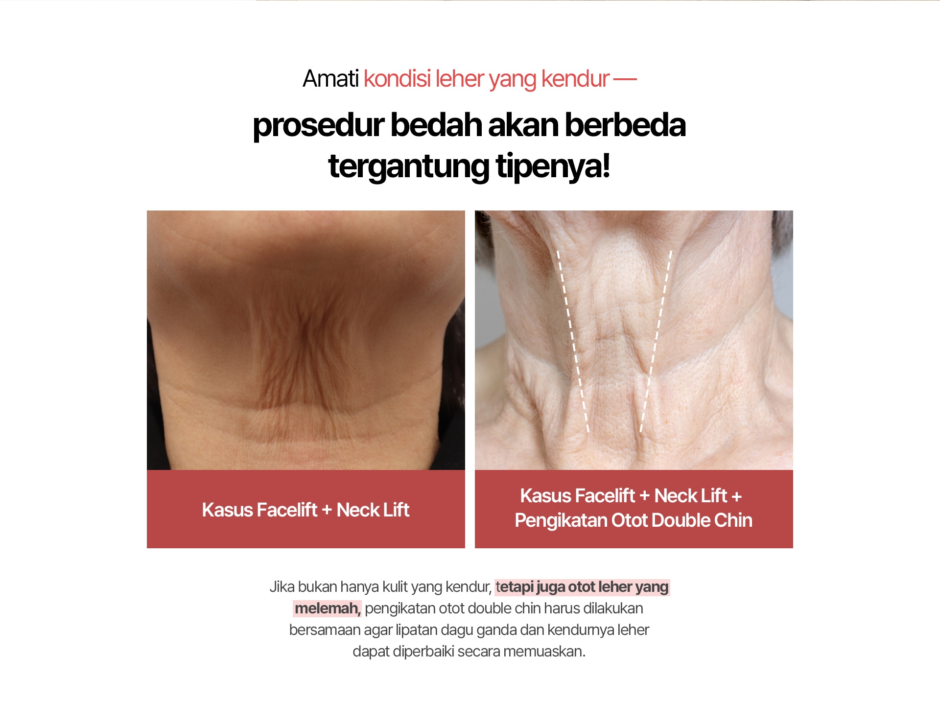Amati kondisi leher yang kendur — prosedur bedah akan berbeda tergantung tipenya! Kasus Facelift + Neck Lift / Kasus Facelift + Neck Lift + Pengikatan Otot Double Chin Jika bukan hanya kulit yang kendur, tetapi juga otot leher yang melemah, pengikatan otot double chin harus dilakukan bersamaan agar lipatan dagu ganda dan kendurnya leher dapat diperbaiki secara memuaskan.