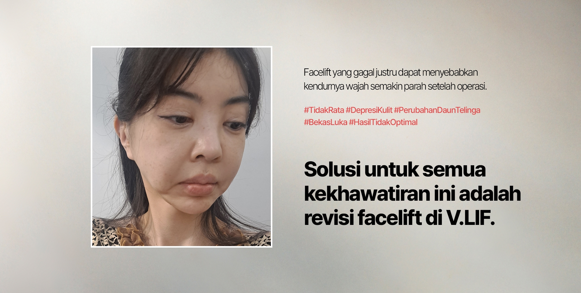 Facelift yang gagal justru dapat menyebabkan kendurnya wajah semakin parah setelah operasi. #TidakRata #DepresiKulit #PerubahanDaunTelinga #BekasLuka #HasilTidakOptimal Solusi untuk semua kekhawatiran ini adalah revisi facelift di V.LIF.