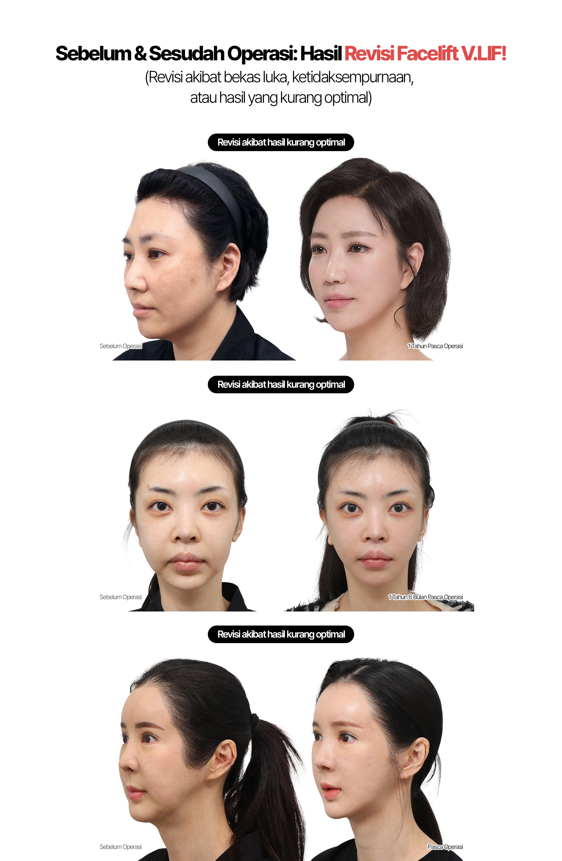 Sebelum & Sesudah Operasi: Hasil Revisi Facelift V.LIF! (Revisi akibat bekas luka, ketidaksempurnaan, atau hasil yang kurang optimal) Revisi akibat hasil kurang optimal Sebelum Operasi 1 Tahun Pasca Operasi Revisi akibat hasil kurang optimal Sebelum Operasi 1 Tahun 6 Bulan Pasca Operasi Revisi akibat hasil kurang optimal Sebelum Operasi Pasca Operasi
