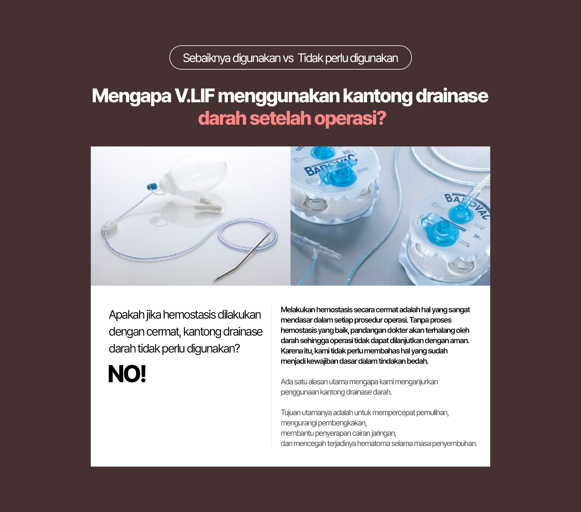 Sebaiknya digunakan vs  Tidak perlu digunakan Mengapa VLIF menggunakan kantong drainase darah setelah operasi? Melakukan hemostasis secara cermat adalah hal yang sangat mendasar dalam setiap prosedur operasi. Tanpa proses hemostasis yang baik, pandangan dokter akan terhalang oleh darah sehingga operasi tidak dapat dilanjutkan dengan aman. Karena itu, kami tidak perlu membahas hal yang sudah menjadi kewajiban dasar dalam tindakan bedah. Ada satu alasan utama mengapa kami menganjurkan penggunaan kantong drainase darah. Tujuan utamanya adalah untuk mempercepat pemulihan, mengurangi pembengkakan, membantu penyerapan cairan jaringan, dan mencegah terjadinya hematoma selama masa penyembuhan.
