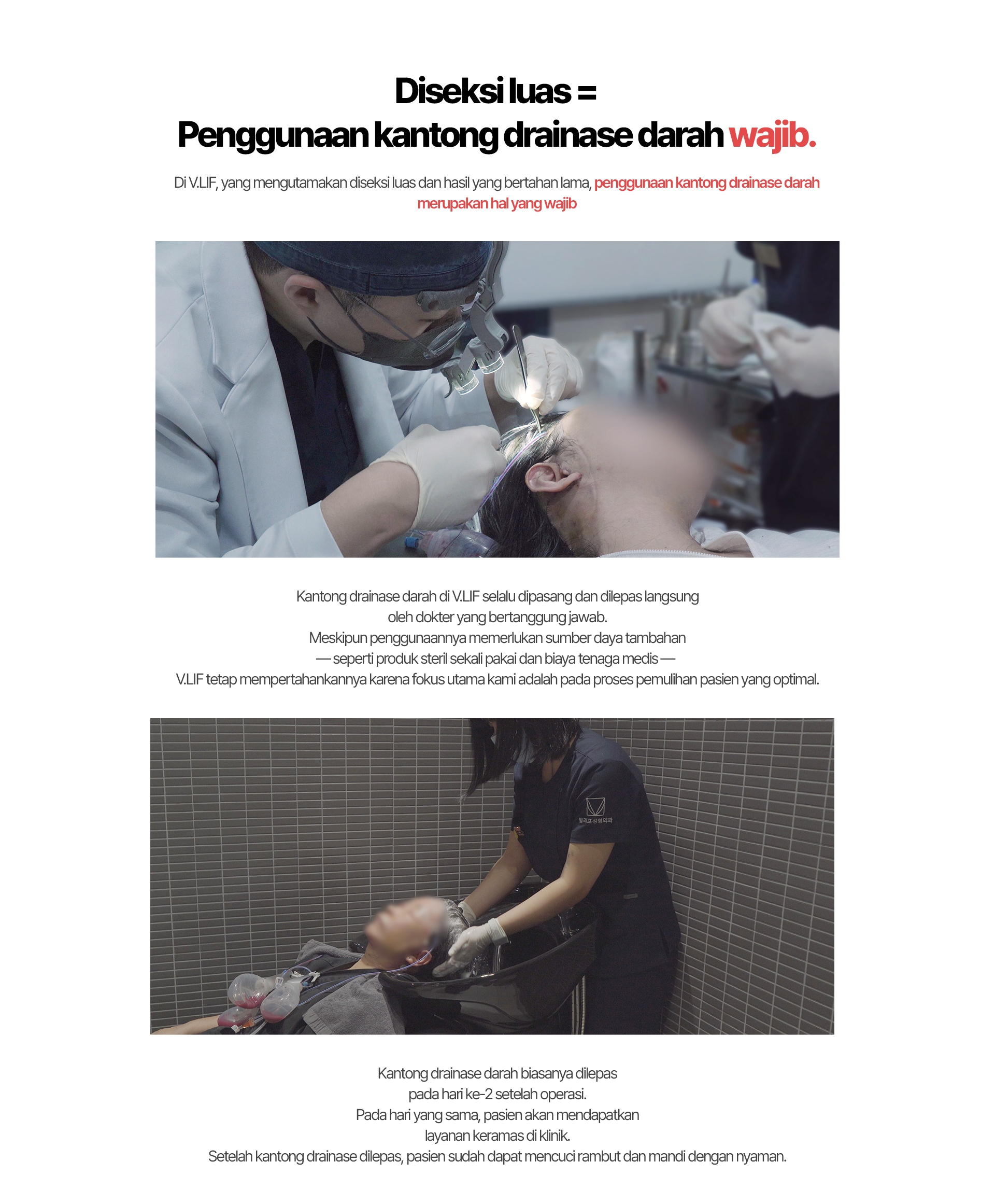 Diseksi luas = Penggunaan kantong drainase darah wajib. Di V.LIF, yang mengutamakan diseksi luas dan hasil yang bertahan lama, penggunaan kantong drainase darah merupakan hal yang wajib. Kantong drainase darah di V.LIF selalu dipasang dan dilepas langsung oleh dokter yang bertanggung jawab. Meskipun penggunaannya memerlukan sumber daya tambahan — seperti produk steril sekali pakai dan biaya tenaga medis — V.LIF tetap mempertahankannya karena fokus utama kami adalah pada proses pemulihan pasien yang optimal. Kantong drainase darah biasanya dilepas pada hari ke-2 setelah operasi. Pada hari yang sama, pasien akan mendapatkan layanan keramas di klinik. Setelah kantong drainase dilepas, pasien sudah dapat mencuci rambut dan mandi dengan nyaman.