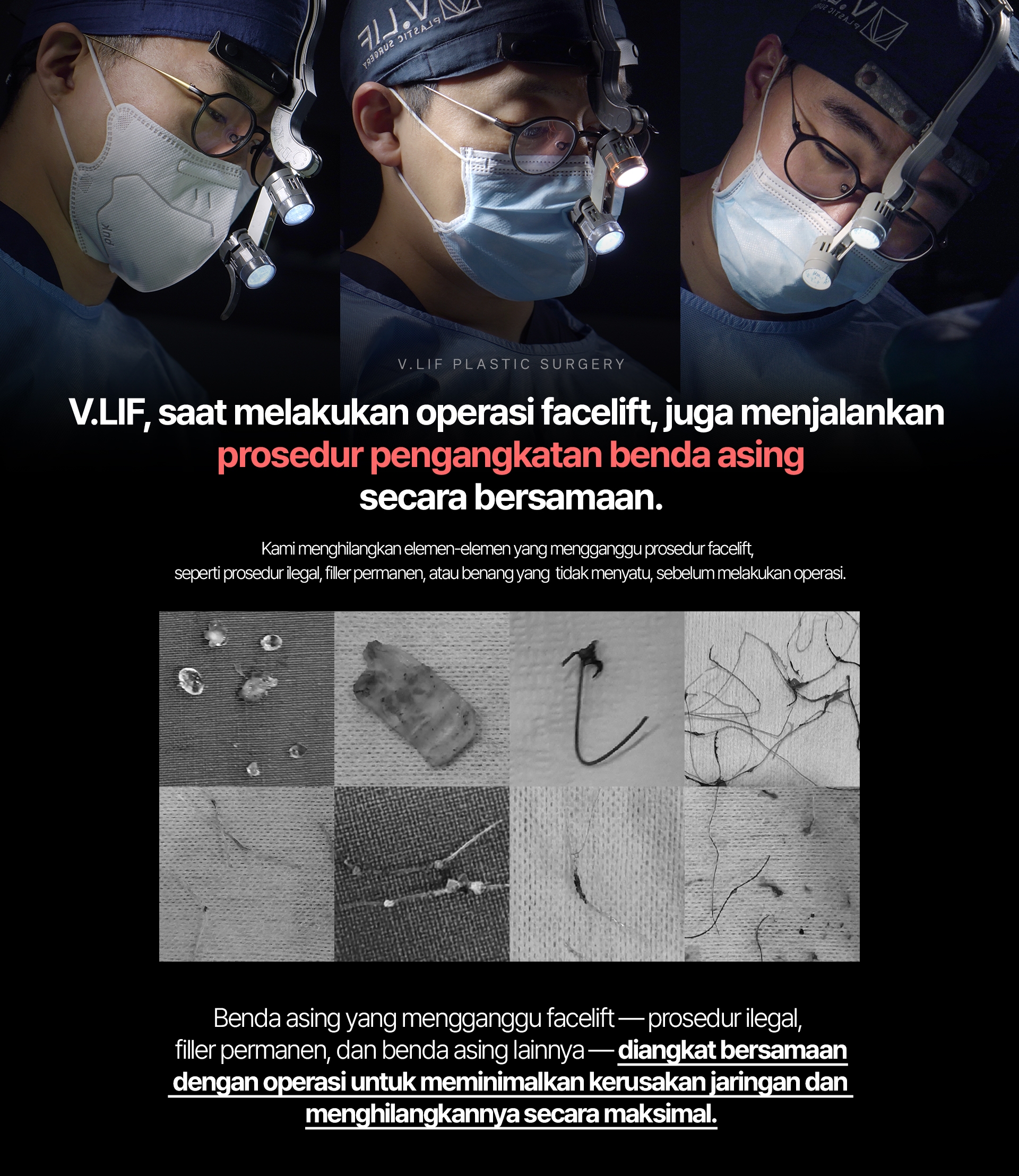 V.LIF, saat melakukan operasi facelift, juga menjalankan prosedur pengangkatan benda asing secara bersamaan. Kami menghilangkan elemen-elemen yang mengganggu prosedur facelift, seperti prosedur ilegal, filler permanen, atau benang yang tidak menyatu, sebelum melakukan operasi. Benda asing yang mengganggu facelift — prosedur ilegal, filler permanen, dan benda asing lainnya — diangkat bersamaan dengan operasi untuk meminimalkan kerusakan jaringan dan menghilangkannya secara maksimal.