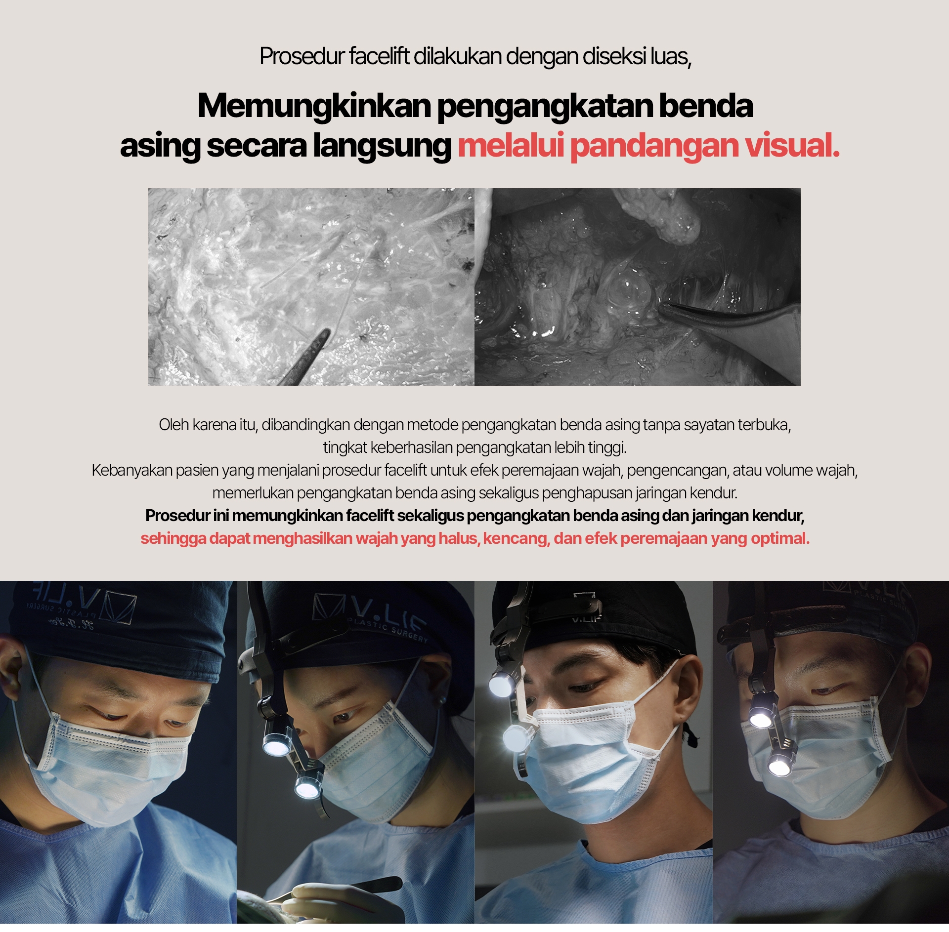 Prosedur facelift dilakukan dengan diseksi luas, memungkinkan pengangkatan benda asing secara langsung melalui pandangan visual. Oleh karena itu, dibandingkan dengan metode pengangkatan benda asing tanpa sayatan terbuka, tingkat keberhasilan pengangkatan lebih tinggi. Kebanyakan pasien yang menjalani prosedur facelift untuk efek peremajaan wajah, pengencangan, atau volume wajah, memerlukan pengangkatan benda asing sekaligus penghapusan jaringan kendur. Prosedur ini memungkinkan facelift sekaligus pengangkatan benda asing dan jaringan kendur, sehingga dapat menghasilkan wajah yang halus, kencang, dan efek peremajaan yang optimal.