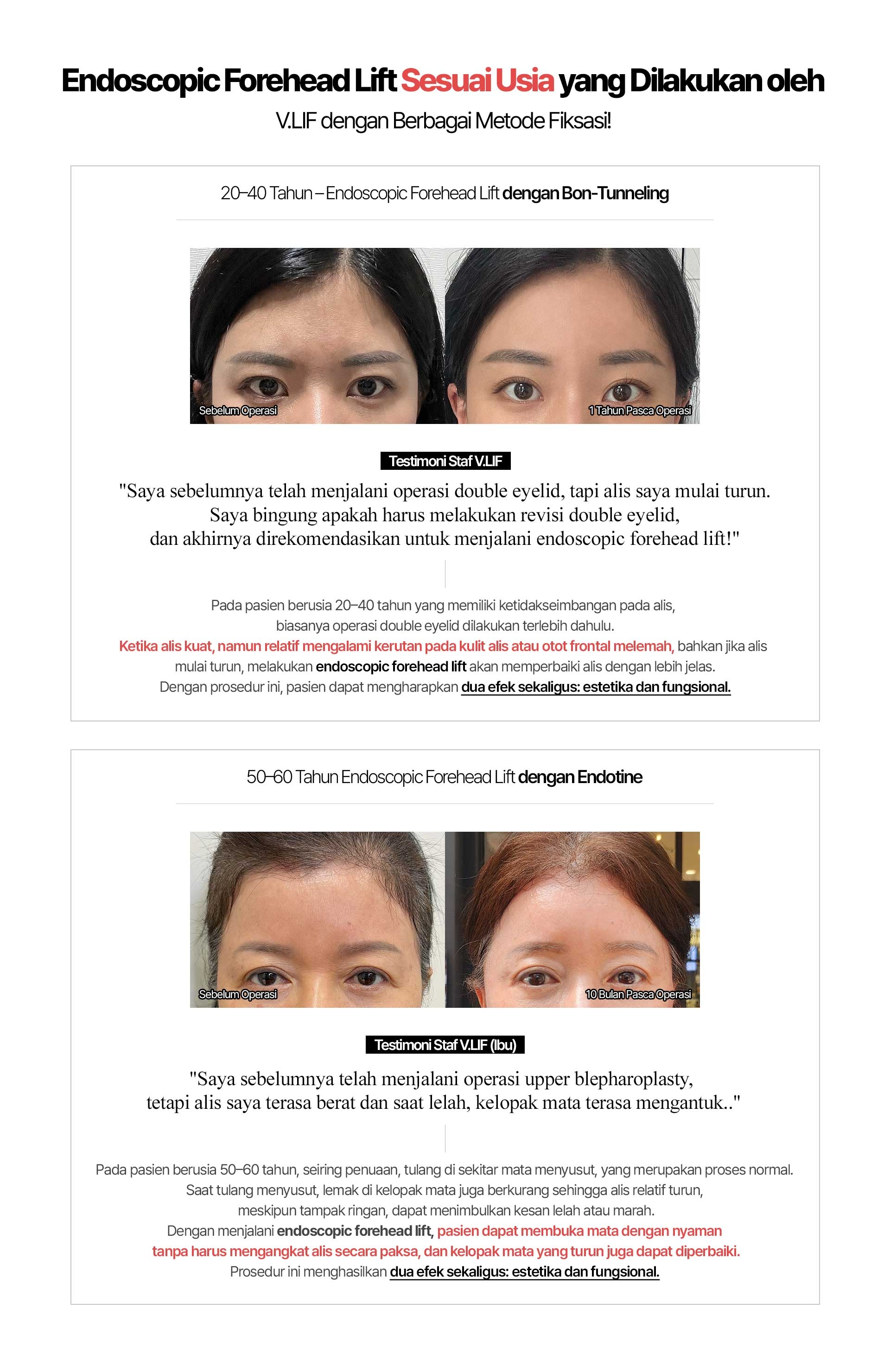 Endoscopic Forehead Lift Sesuai Usia yang Dilakukan oleh V.LIF dengan Berbagai Metode Fiksasi! 20–40 Tahun – Endoscopic Forehead Lift dengan Bon-Tunneling Testimoni Staf V.LIF: Saya sebelumnya telah menjalani operasi double eyelid, tapi alis saya mulai turun. Saya bingung apakah harus melakukan revisi double eyelid, dan akhirnya direkomendasikan untuk menjalani endoscopic forehead lift! Pada pasien berusia 20–40 tahun yang memiliki ketidakseimbangan pada alis, biasanya operasi double eyelid dilakukan terlebih dahulu. Ketika alis kuat, namun relatif mengalami kerutan pada kulit alis atau otot frontal melemah, bahkan jika alis mulai turun, melakukan endoscopic forehead lift akan memperbaiki alis dengan lebih jelas. Dengan prosedur ini, pasien dapat mengharapkan dua efek sekaligus: estetika dan fungsional. 50–60 Tahun Endoscopic Forehead Lift dengan Endotine Testimoni Staf V.LIF (Ibu): Saya sebelumnya telah menjalani operasi upper blepharoplasty, tetapi alis saya terasa berat dan saat lelah, kelopak mata terasa mengantuk.. Pada pasien berusia 50–60 tahun, seiring penuaan, tulang di sekitar mata menyusut, yang merupakan proses normal. Saat tulang menyusut, lemak di kelopak mata juga berkurang sehingga alis relatif turun, meskipun tampak ringan, dapat menimbulkan kesan lelah atau marah. Dengan menjalani endoscopic forehead lift, pasien dapat membuka mata dengan nyaman tanpa harus mengangkat alis secara paksa, dan kelopak mata yang turun juga dapat diperbaiki. Prosedur ini menghasilkan dua efek sekaligus: estetika dan fungsional.