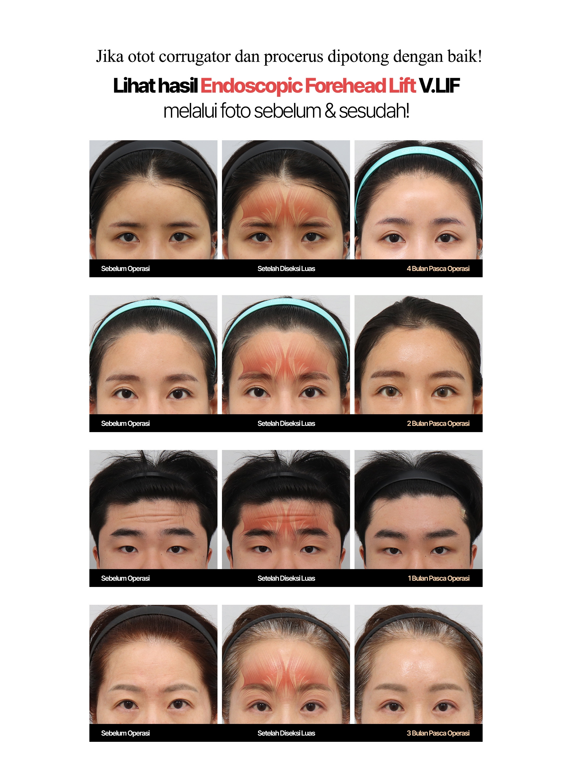 Jika otot corrugator dan procerus dipotong dengan baik! Lihat hasil Endoscopic Forehead Lift V.LIF melalui foto sebelum & sesudah!