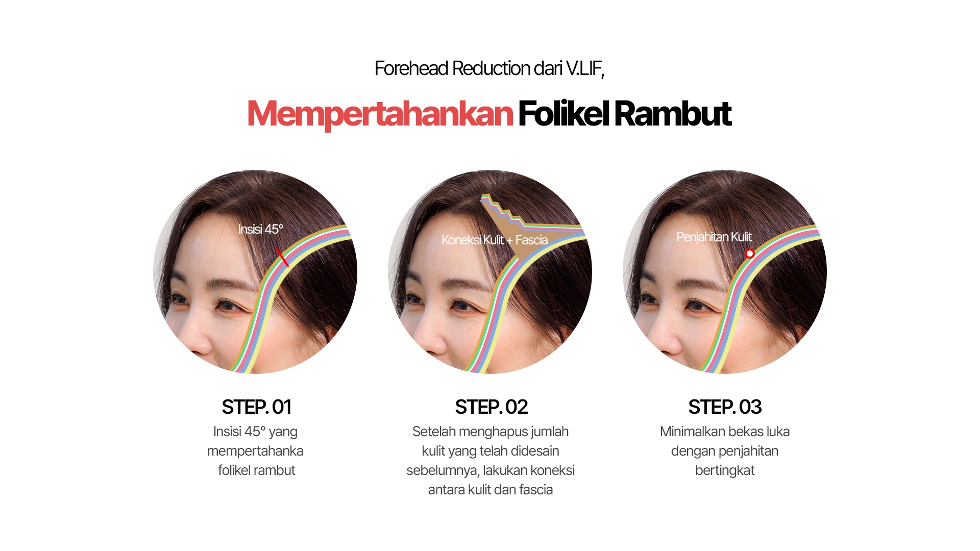 Forehead Reduction dari V.LIF, Mempertahankan Folikel Rambut Insisi 45° Koneksi Kulit + Fascia Koneksi Kulit + Fascia STEP.01 Insisi 45° yang mempertahankan folikel rambut STEP.02 Setelah menghapus jumlah kulit yang telah didesain sebelumnya, lakukan koneksi antara kulit dan fascia STEP.03 Minimalkan bekas luka dengan penjahitan bertingkat