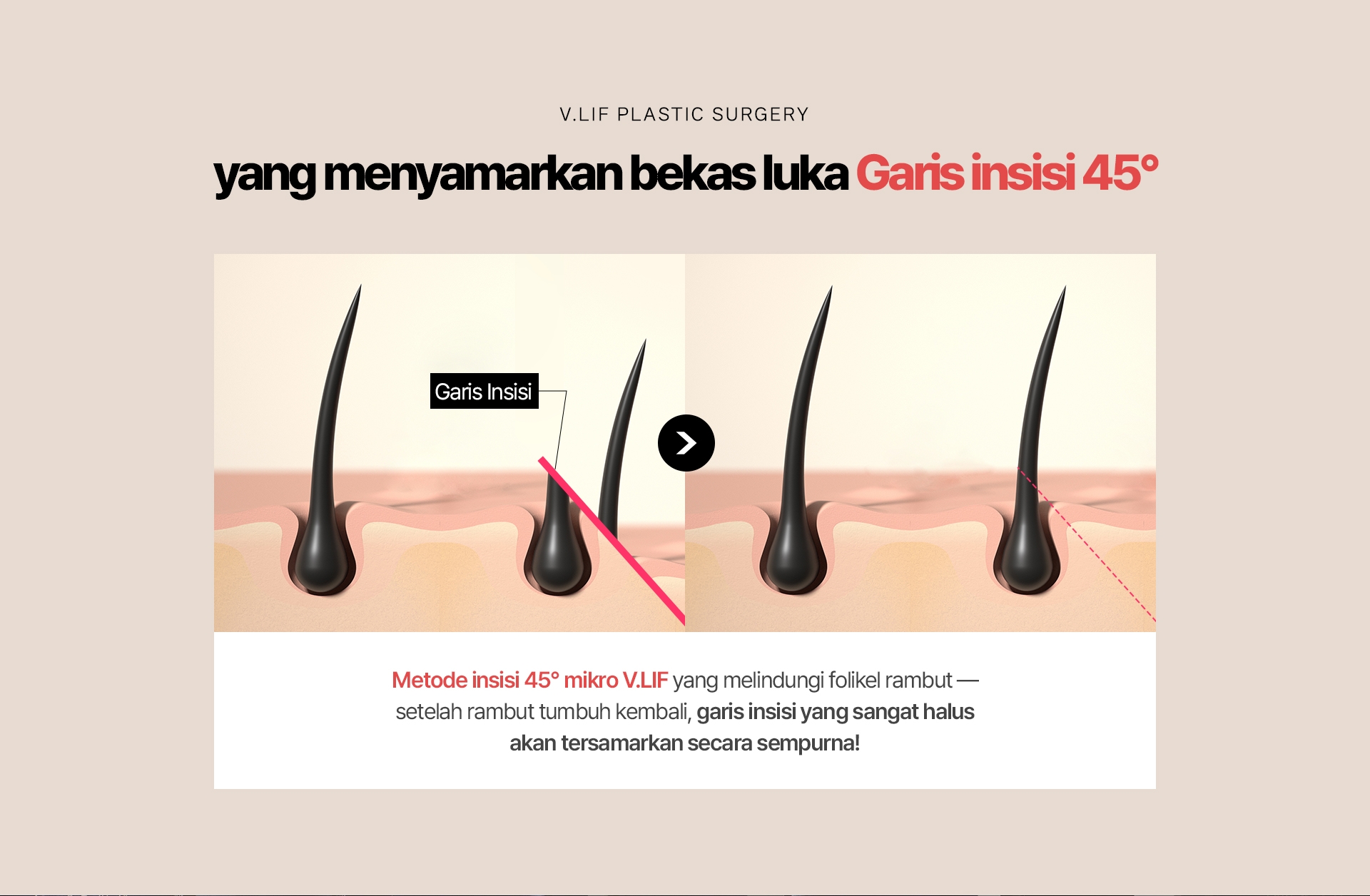 Garis insisi 45° yang menyamarkan bekas luka Metode insisi 45° mikro V.LIF yang melindungi folikel rambut — setelah rambut tumbuh kembali, garis insisi yang sangat halus akan tersamarkan secara sempurna!