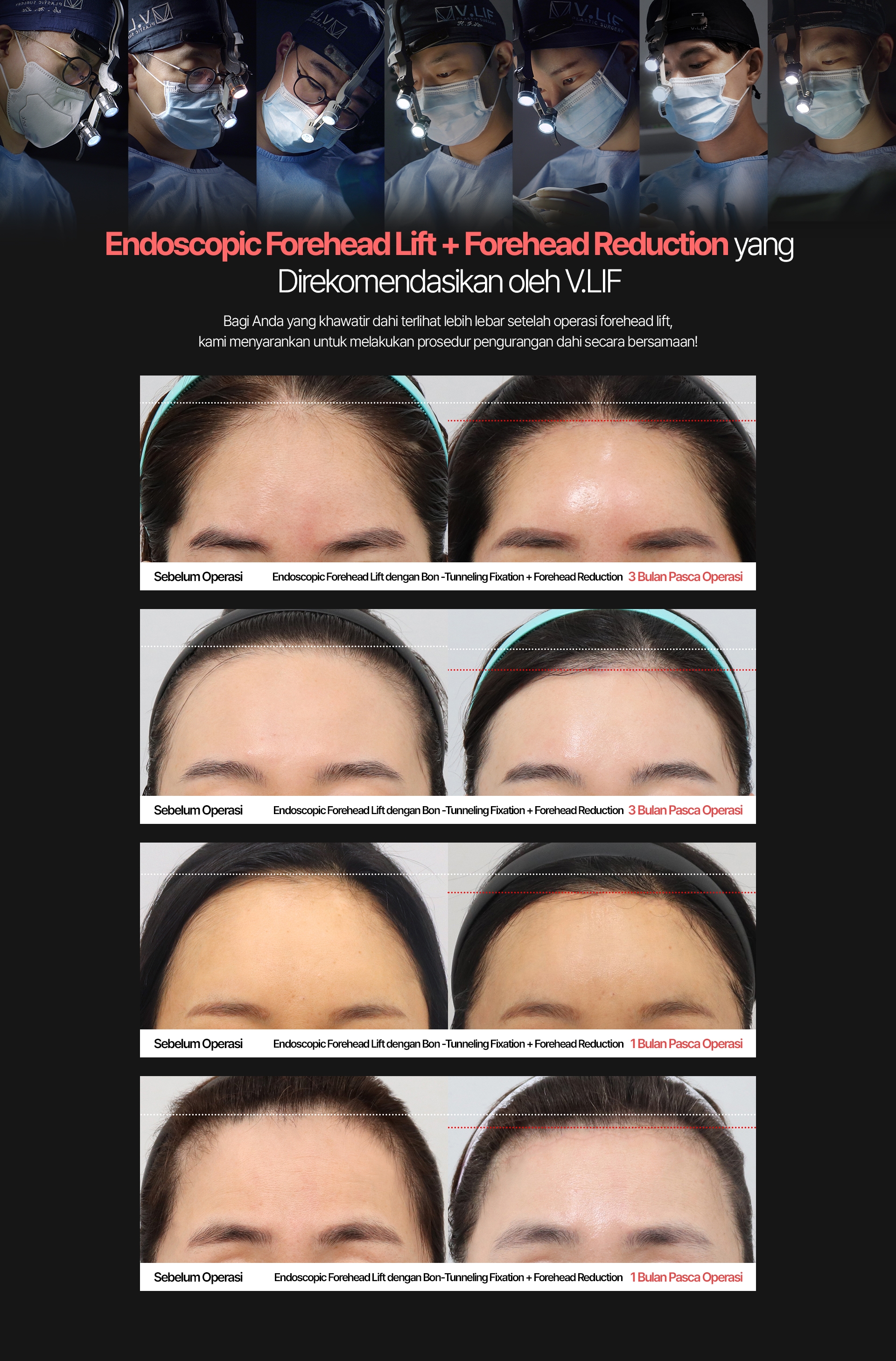 Endoscopic Forehead Lift + Forehead Reduction yang Direkomendasikan oleh V.LIF Bagi Anda yang khawatir dahi terlihat lebih lebar setelah operasi forehead lift, kami menyarankan untuk melakukan prosedur pengurangan dahi secara bersamaan! Sebelum Operasi Endoscopic Forehead Lift dengan Bon-Tunneling Fixation + Forehead Reduction 3 Bulan Pasca Operasi Sebelum Operasi Endoscopic Forehead Lift dengan Bon-Tunneling Fixation + Forehead Reduction 3 Bulan Pasca Operasi Sebelum Operasi Endoscopic Forehead Lift dengan Bon-Tunneling Fixation + Forehead Reduction Bulan Pasca Operasi Sebelum Operasi Endoscopic Forehead Lift dengan Bon-Tunneling Fixation + Forehead Reduction 1 Bulan Pasca Operasi