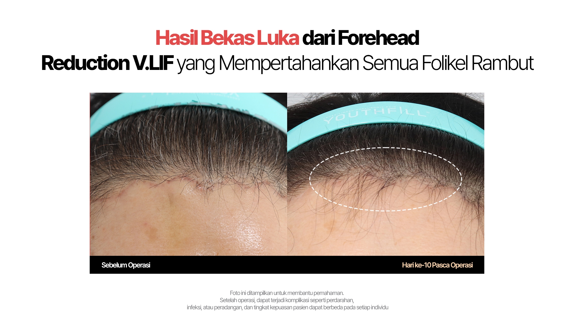Hasil Bekas Luka dari Forehead Reduction V.LIF yang Mempertahankan Semua Folikel Rambut Sebelum Operasi / Hari ke-10 Pasca Operasi Foto ini ditampilkan untuk membantu pemahaman. Setelah operasi, dapat terjadi komplikasi seperti perdarahan, infeksi, atau peradangan, dan tingkat kepuasan pasien dapat berbeda pada setiap individu