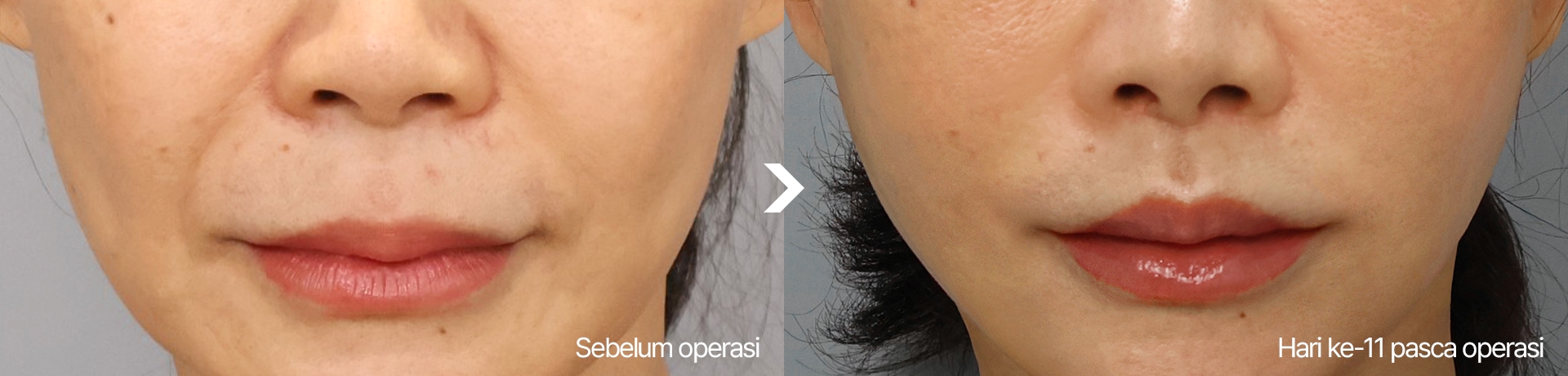 Sebelum operasi Hari ke-11 pasca operasi