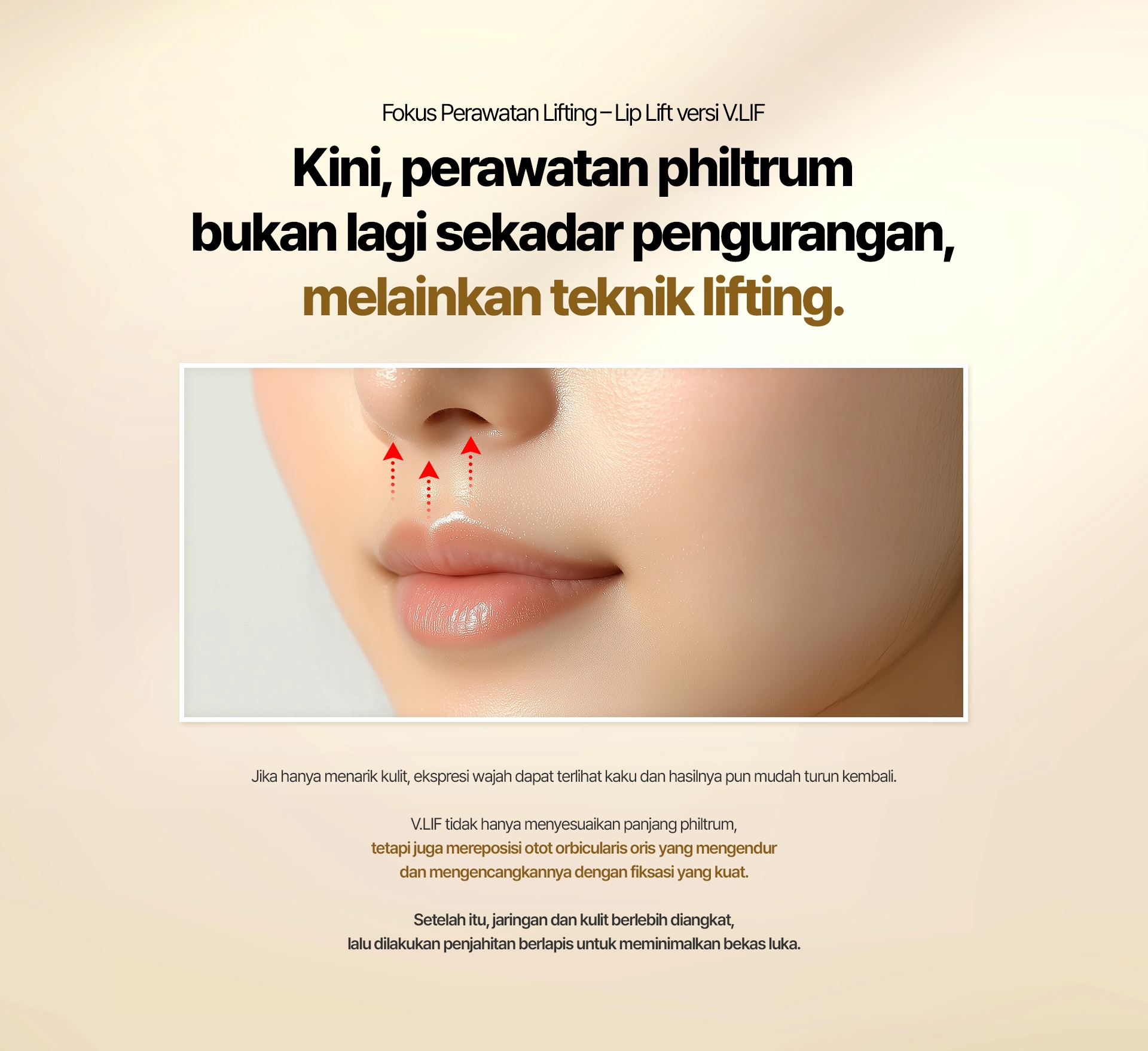 Fokus Perawatan Lifting – Lip Lift versi V.LIF Kini, perawatan philtrum bukan lagi sekadar pengurangan, melainkan teknik lifting. Jika hanya menarik kulit, ekspresi wajah dapat terlihat kaku dan hasilnya pun mudah turun kembali. V.LIF tidak hanya menyesuaikan panjang philtrum, tetapi juga mereposisi otot orbicularis oris yang mengendur dan mengencangkannya dengan fiksasi yang kuat. Setelah itu, jaringan dan kulit berlebih diangkat, lalu dilakukan penjahitan berlapis untuk meminimalkan bekas luka.