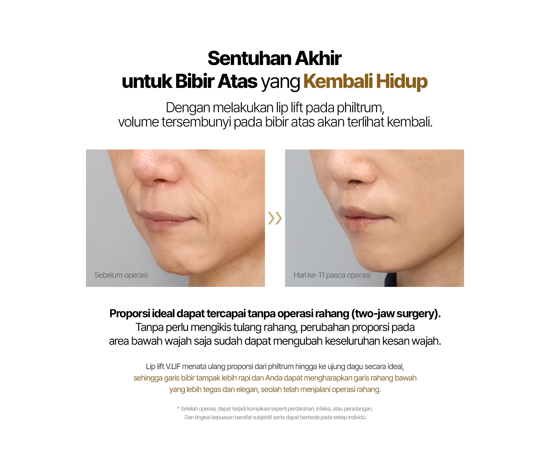 Sentuhan Akhir untuk Bibir Atas yang Kembali Hidup Dengan melakukan lip lift pada philtrum, volume tersembunyi pada bibir atas akan terlihat kembali. Proporsi ideal dapat tercapai tanpa operasi rahang (two-jaw surgery). Tanpa perlu mengikis tulang rahang, perubahan proporsi pada area bawah wajah saja sudah dapat mengubah keseluruhan kesan wajah. Lip lift V.LIF menata ulang proporsi dari philtrum hingga ke ujung dagu secara ideal, sehingga garis bibir tampak lebih rapi dan Anda dapat mengharapkan garis rahang bawah yang lebih tegas dan elegan, seolah telah menjalani operasi rahang. * Setelah operasi, dapat terjadi kompikasi seperti perdarahan, infeksi, atau peradangan, Dan tingkat kepuasan bersifat subjektif serta dapat berbeda pada setiap individu.